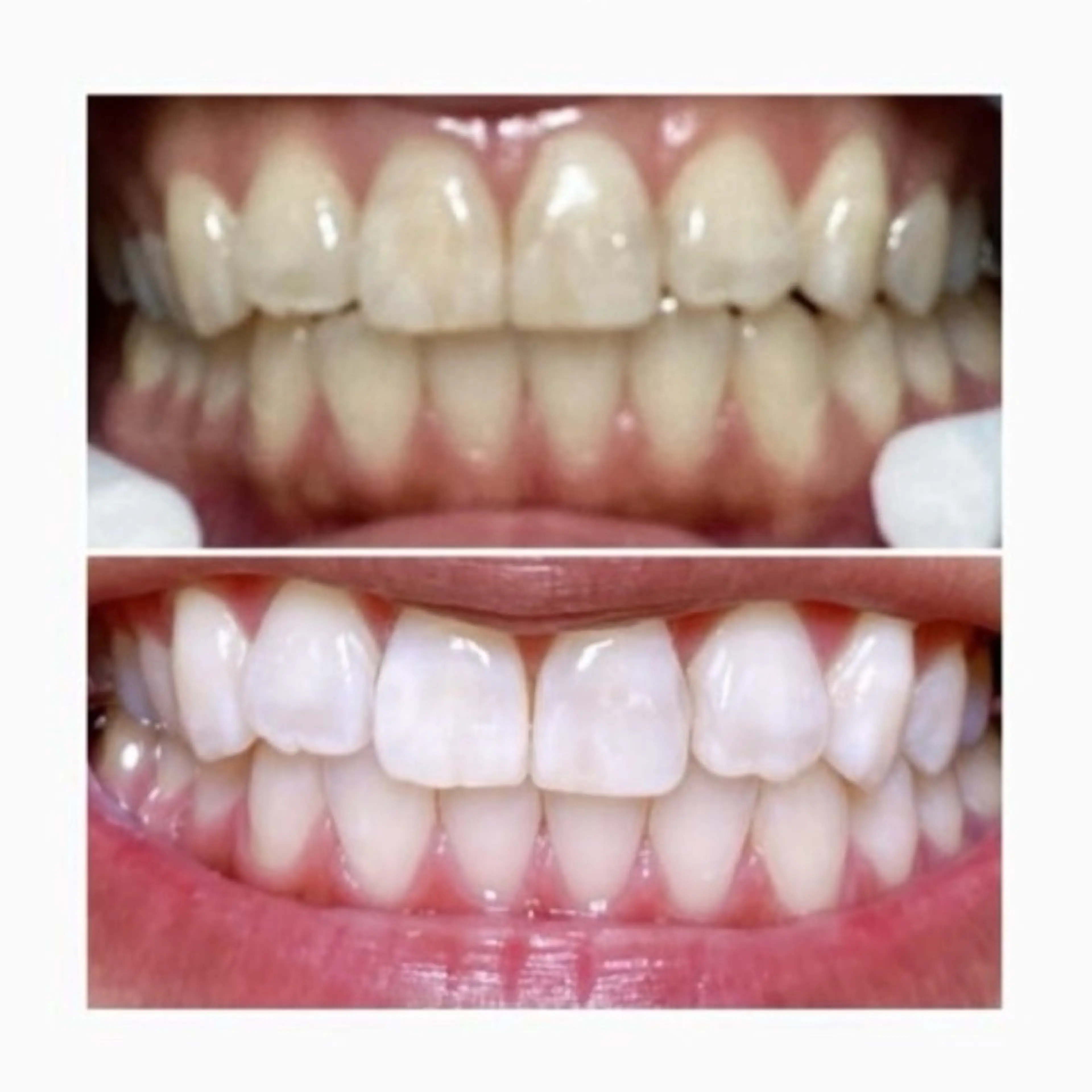 ネイル/耳つぼ /新ホワイトニングのネイルデザイン