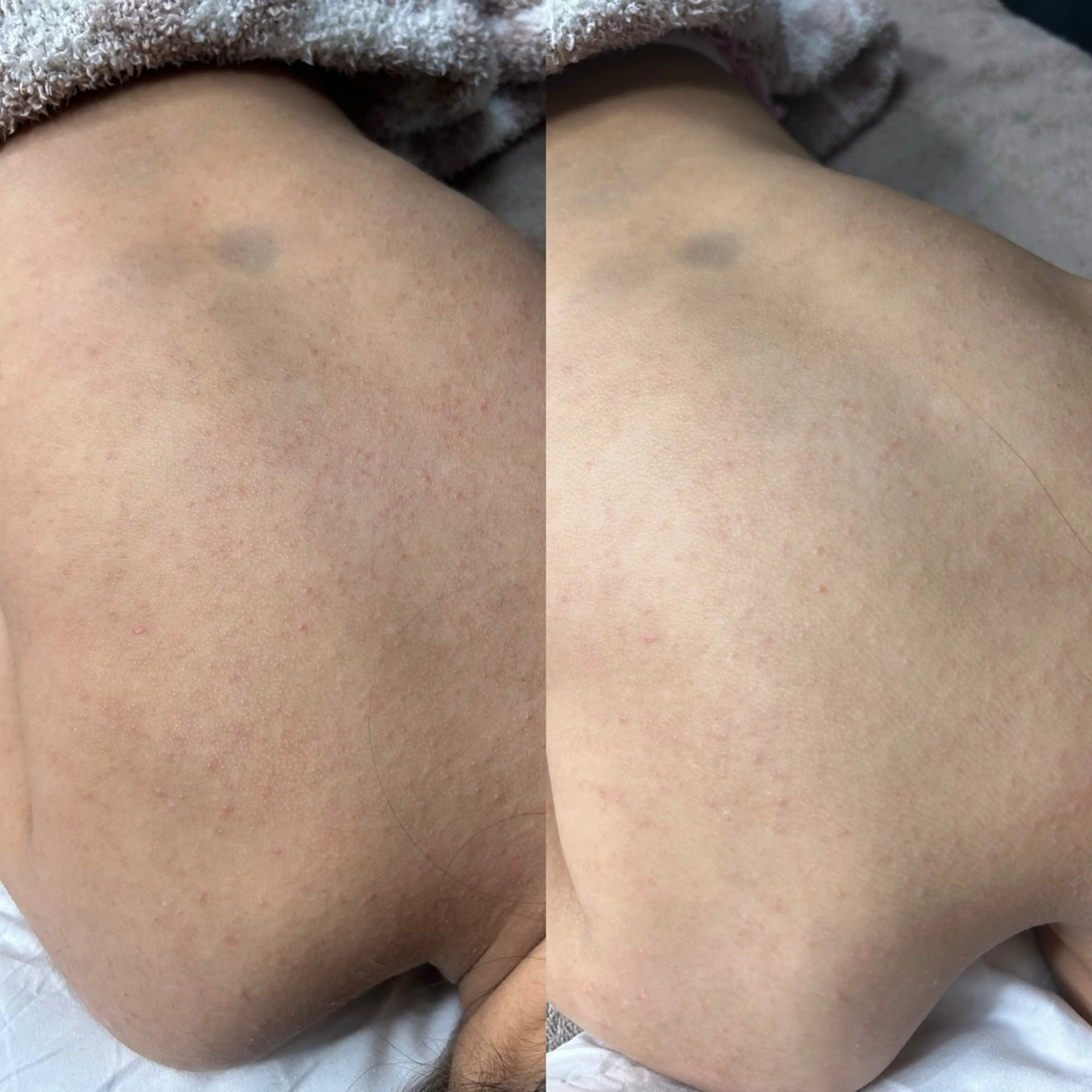 背中orデコルテ　パックの写真