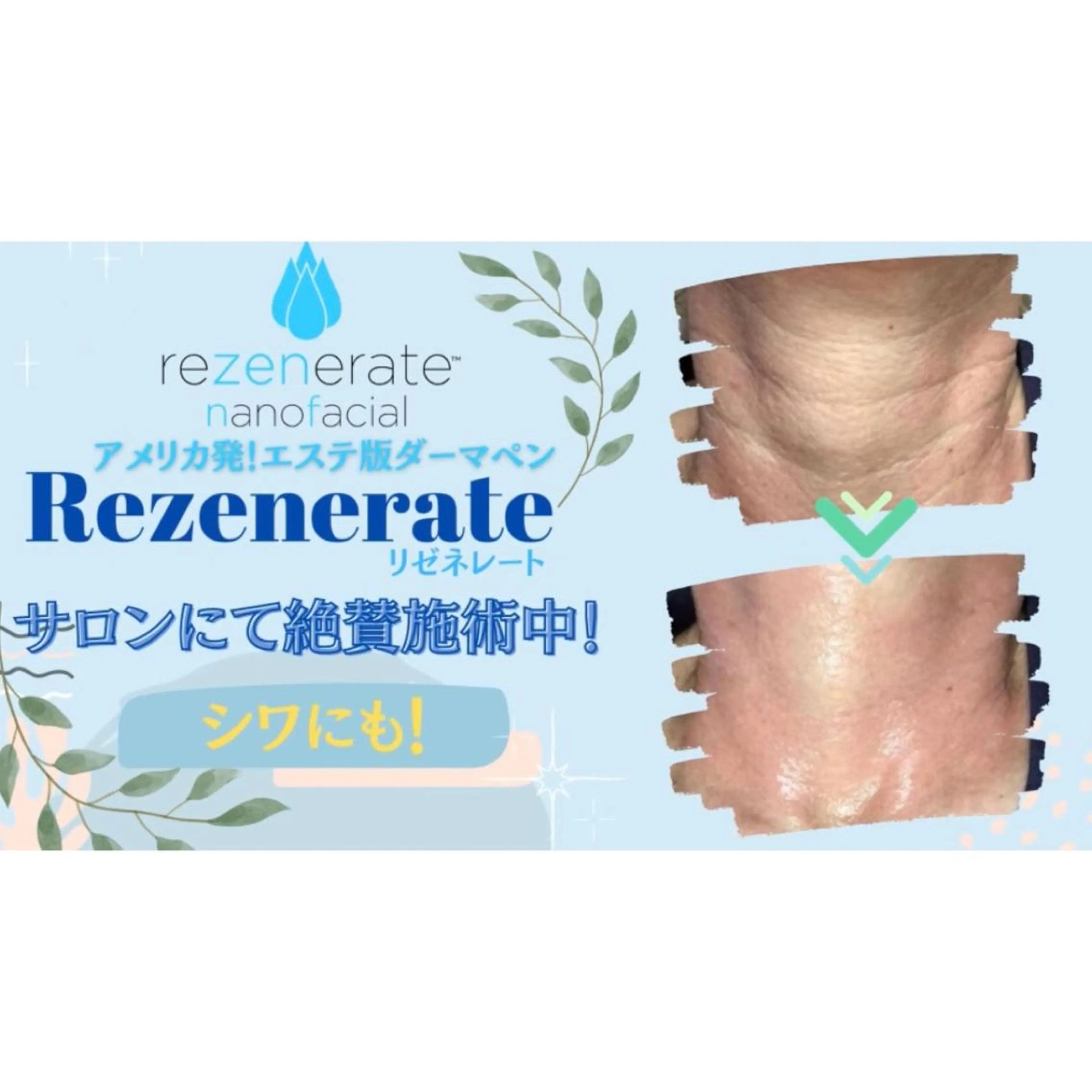 【✨首のシワ専門コース✨】リゼネレート肌再生ナノニードルフェイシャル（45分）の写真