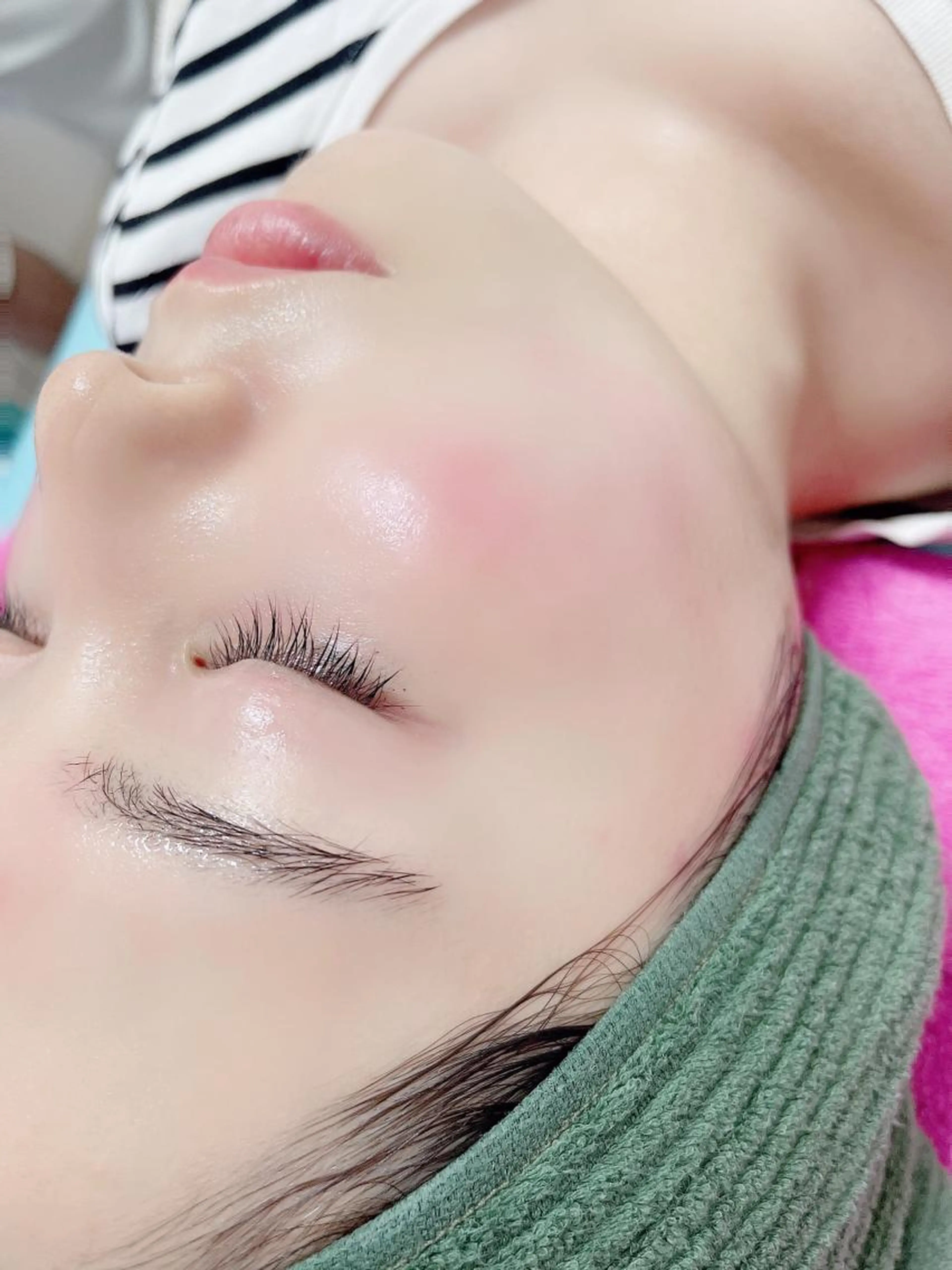 ✨ミニモ限定✨ 【美容鍼】肌質集中ケア50分 メンズも大歓迎 通常12,000円⇒10,000円の写真