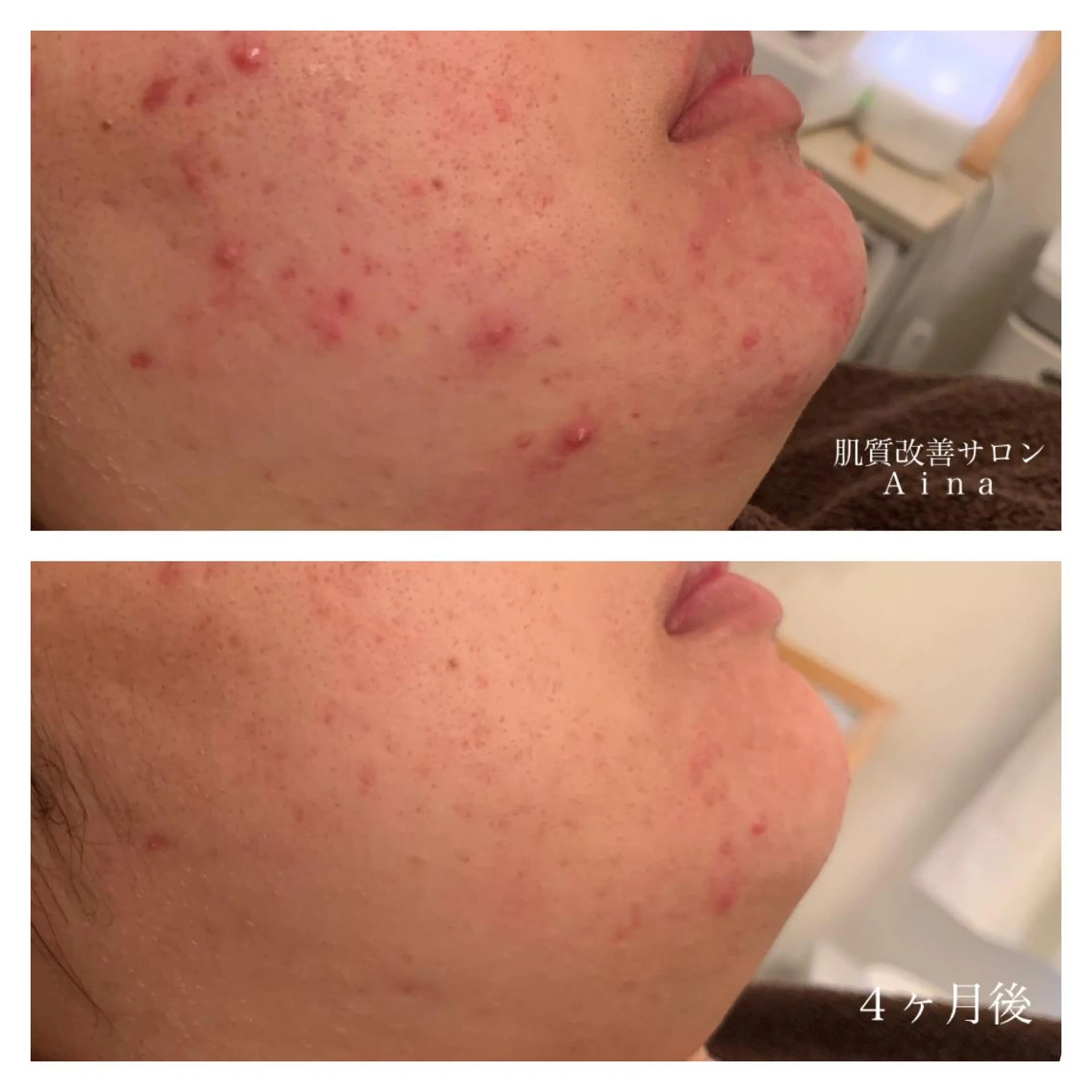 セミロング カラー パーマ ヘアアレンジ キッズ ネイル マツエク・マツパ ニキビ跡専門サロン Ainaのエステ・リラクイメージ