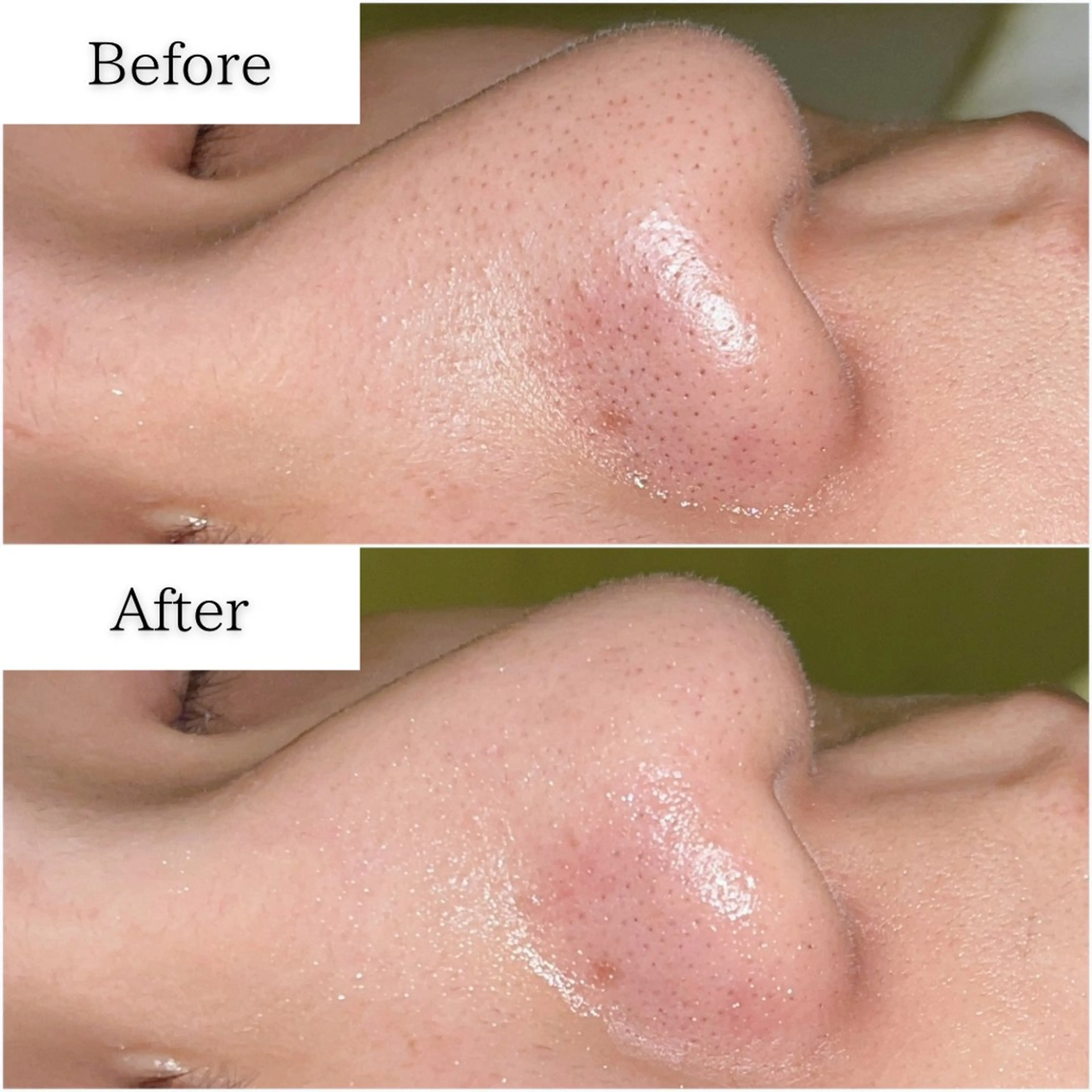 【平日限定】毛穴洗浄ハイドロスプラッシュ※男女OK！の写真