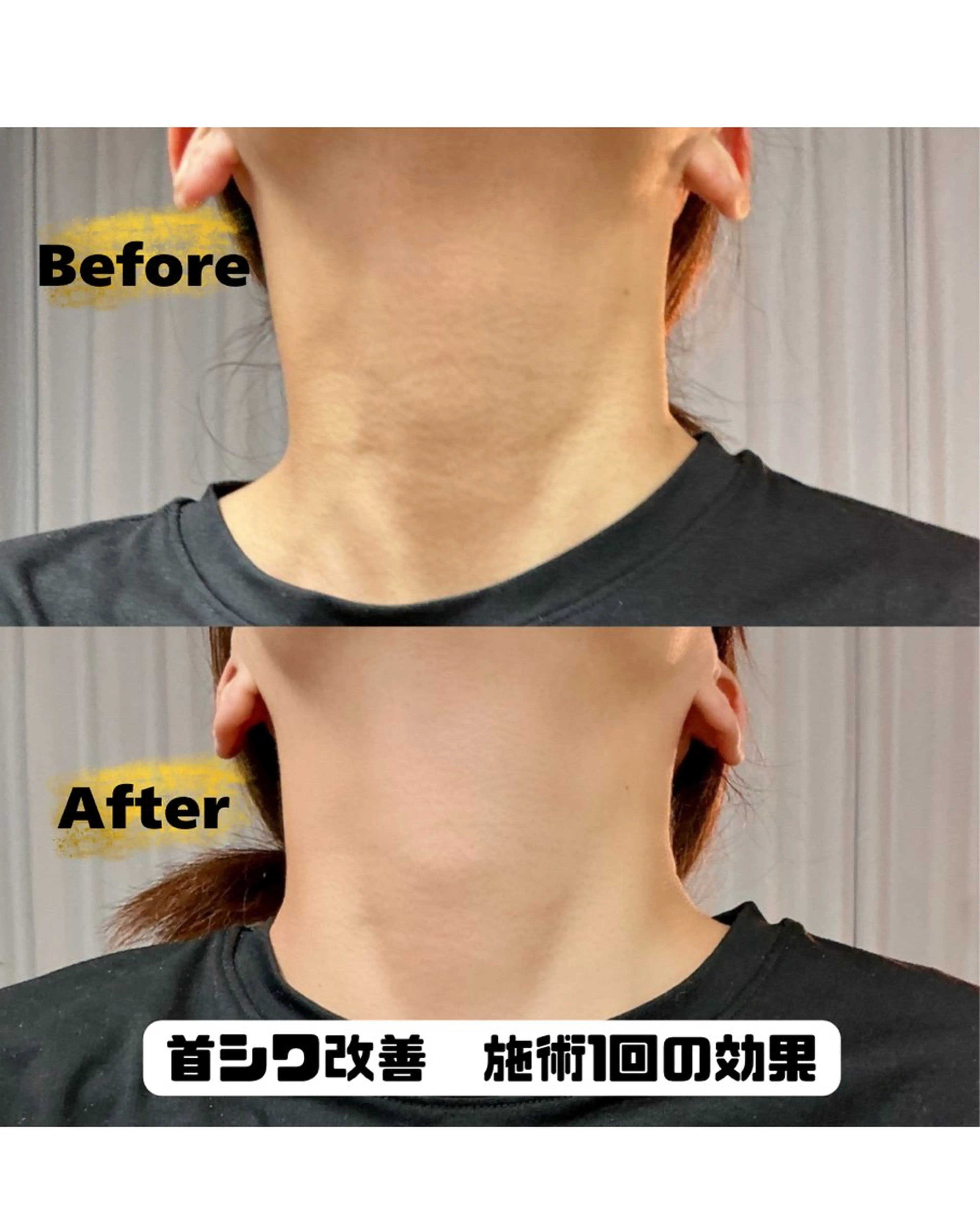 45歳​〜​55歳の方限定🙋🏼‍♀️　ストレートネック➕首皺撃退⚡️の写真