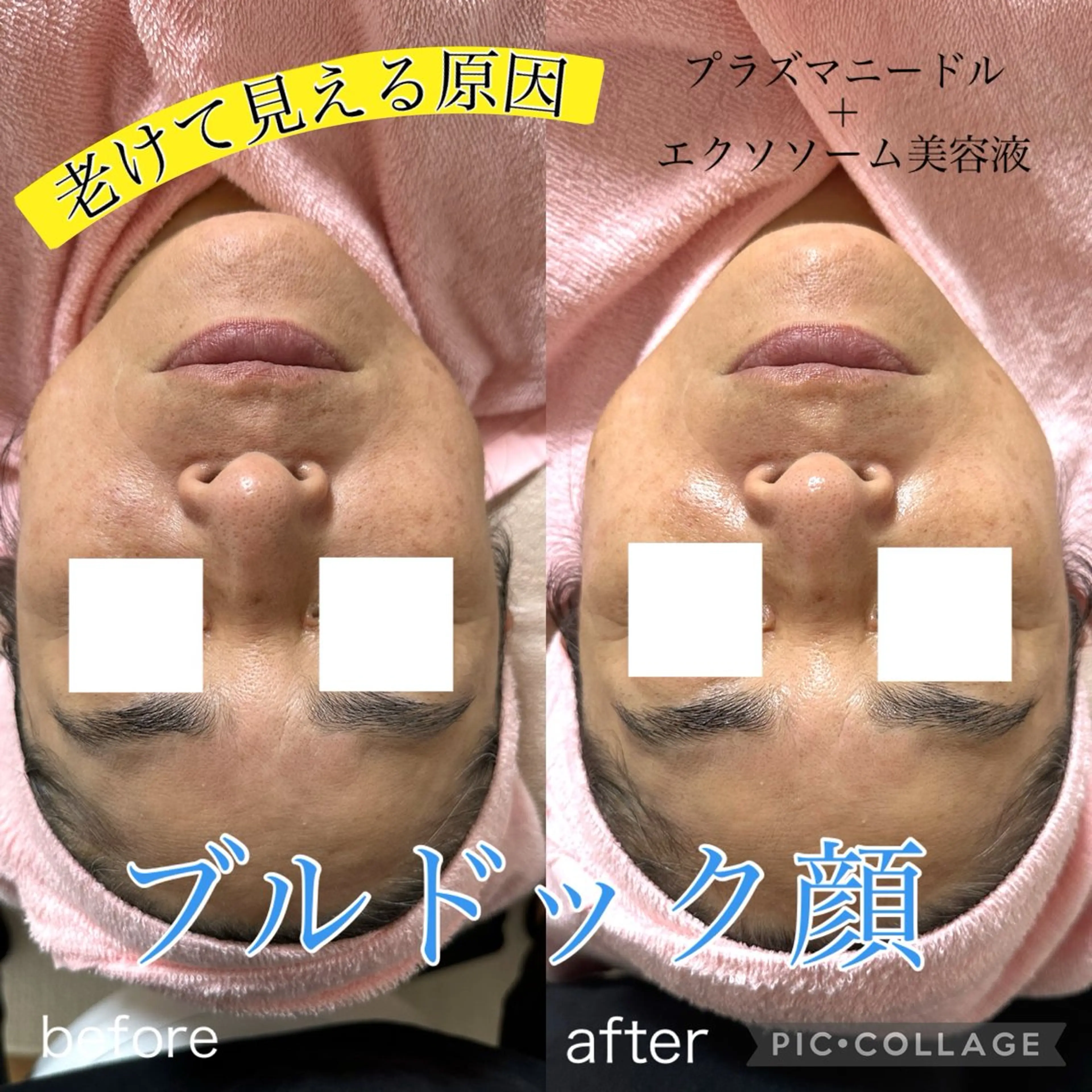 たるみ/シワ/くすみ/開き毛穴/ニキビに⭐️フェイシャル&デコルテ背中マッサージ付き【小顔プラズマエステ】の写真