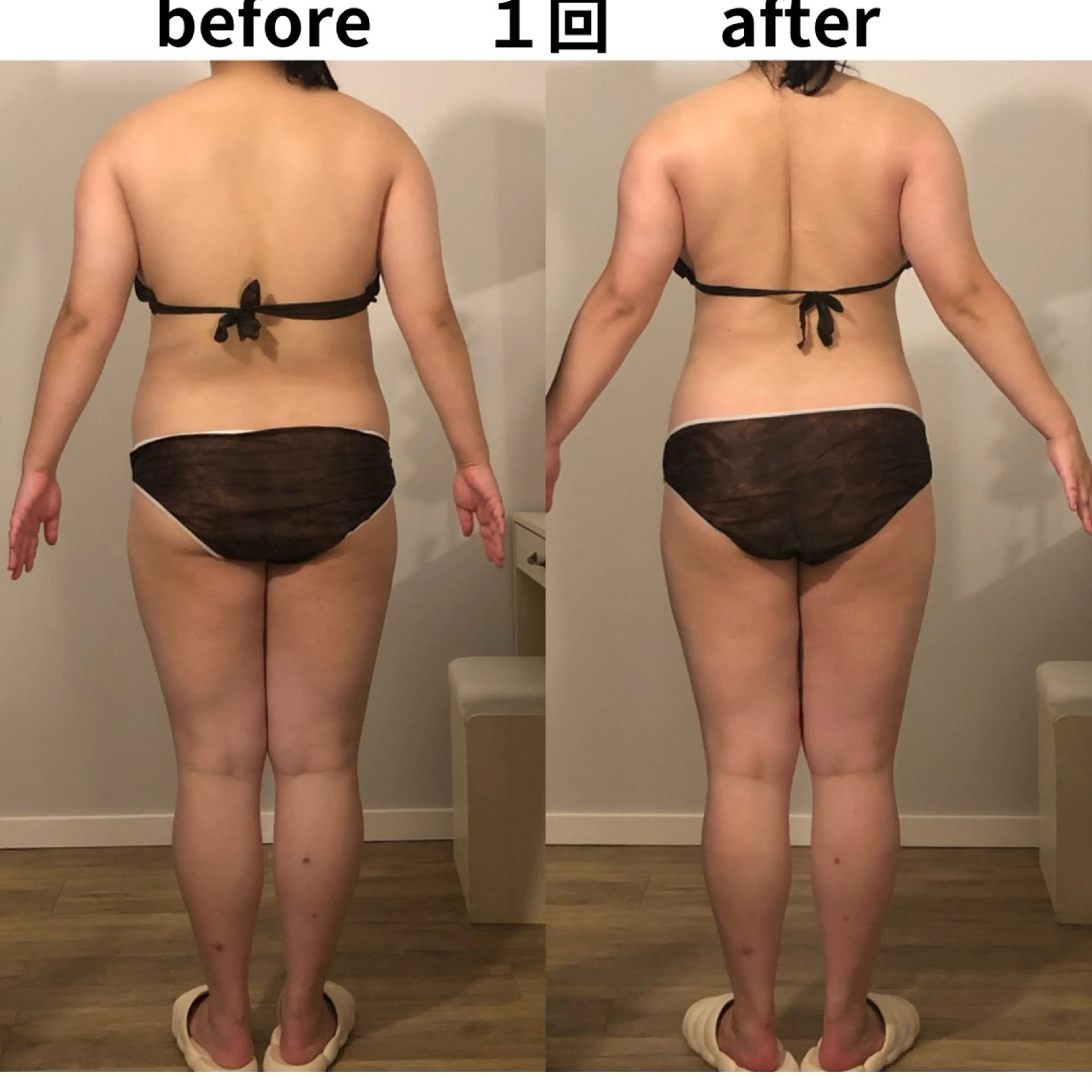 全身燃焼デトックス痩身120分🔥ラジオ波×痩身ハンドで全身むくみ・セルライト徹底ケアの写真