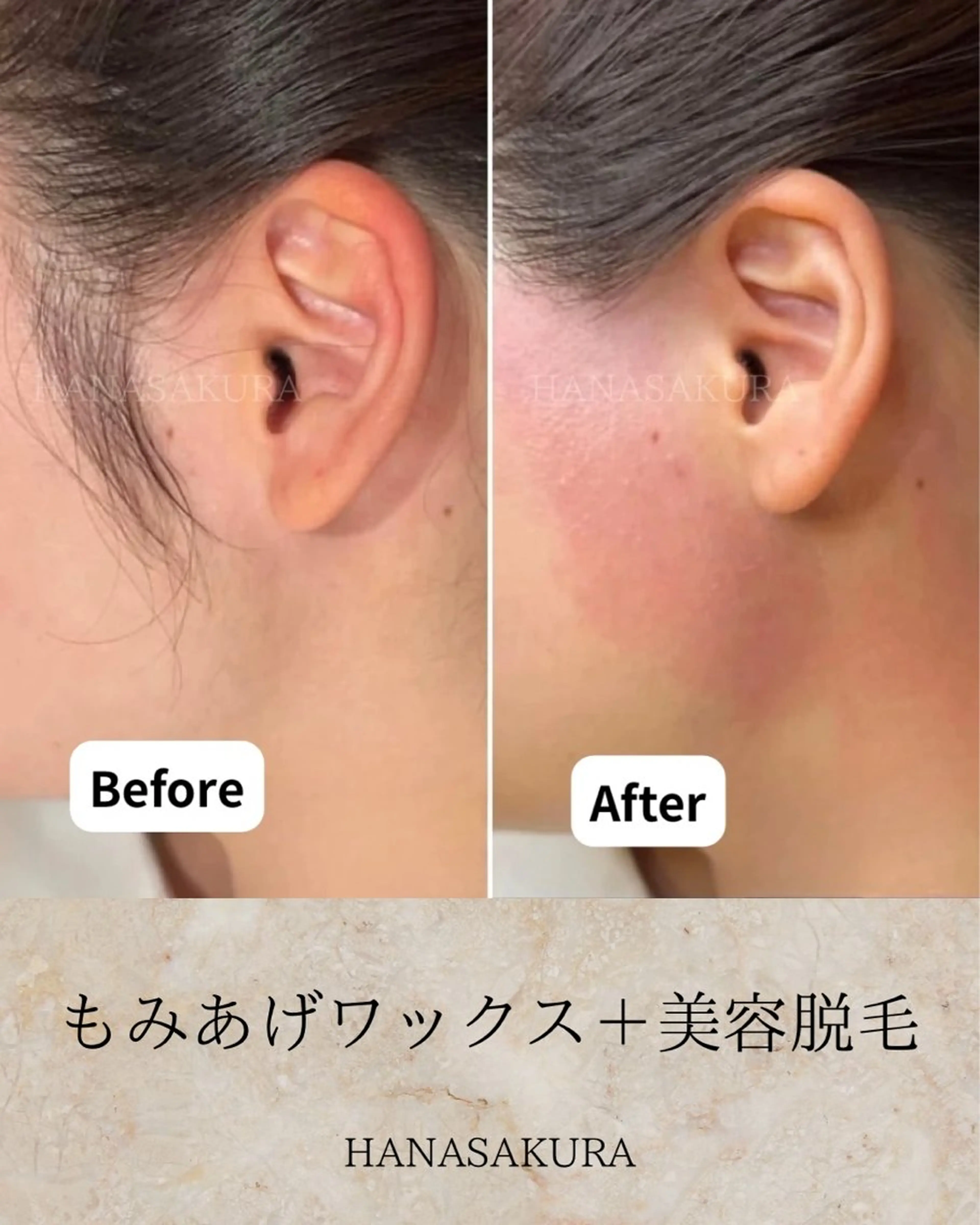 もみあげワックス脱毛+美容脱毛(要口コミ)の写真