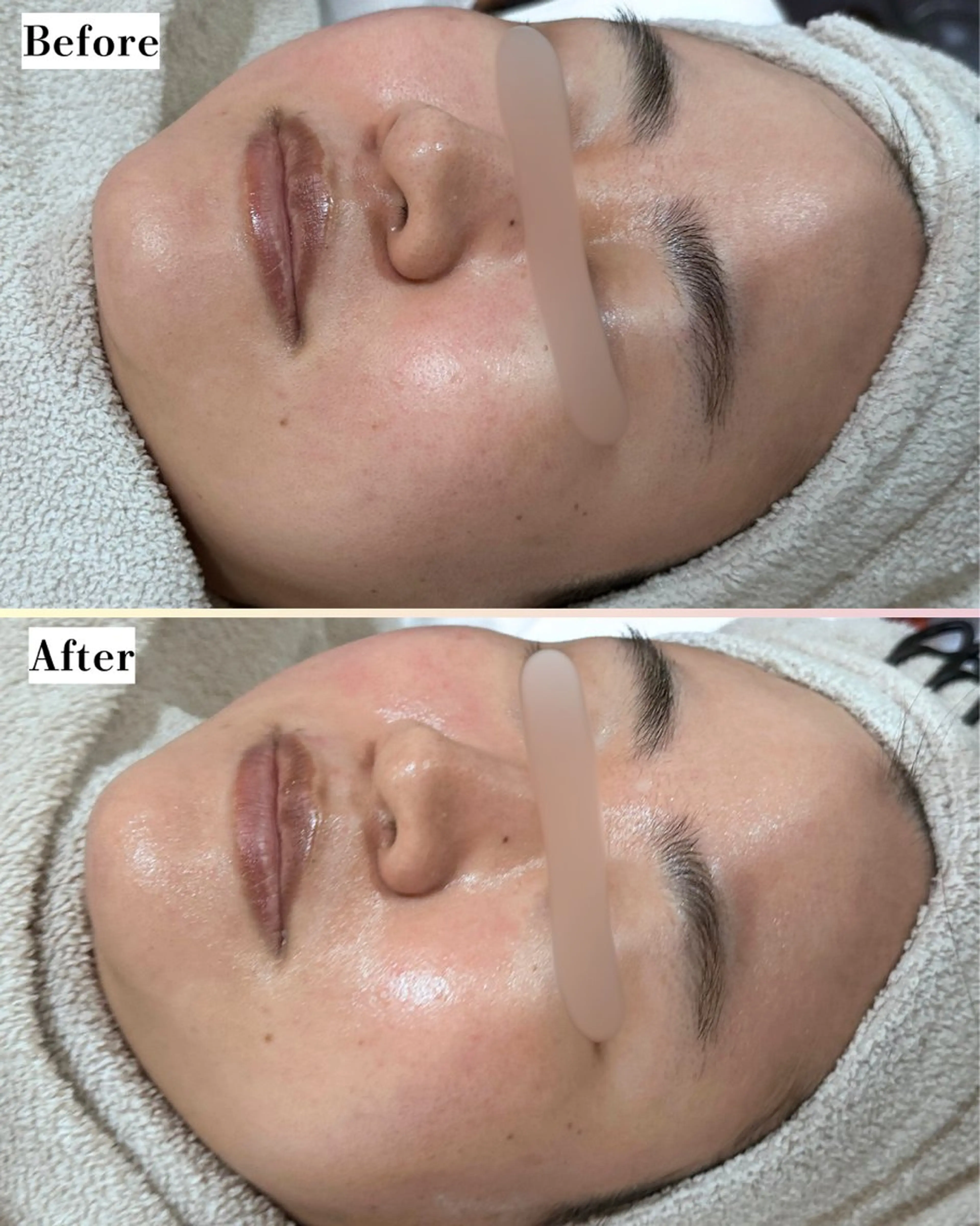 エステ |ピーリング・毛穴| soina神楽坂のエステ・リラクイメージ