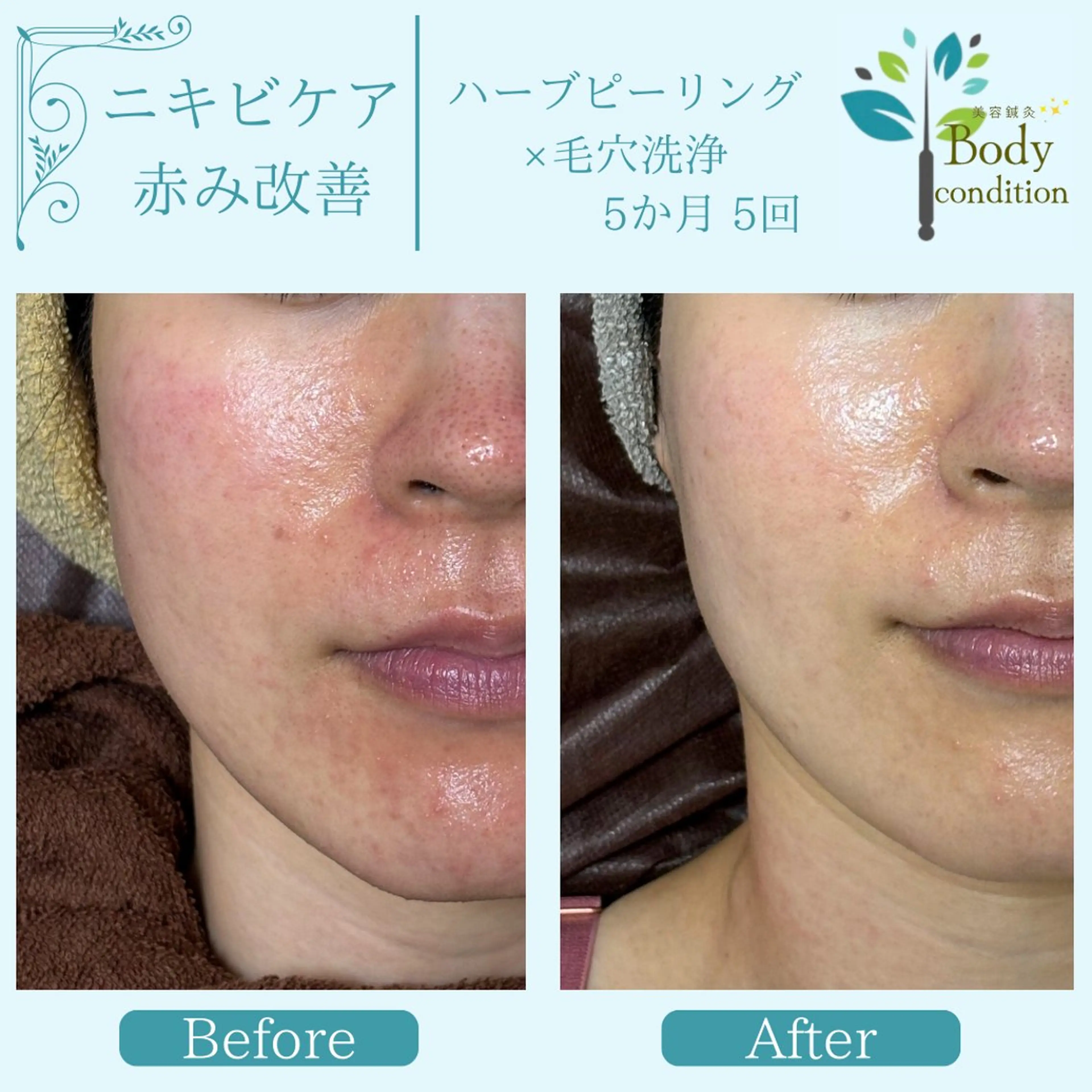 小顔ハーブピーリング 美容鍼/毛穴洗浄のエステ・リラクイメージ