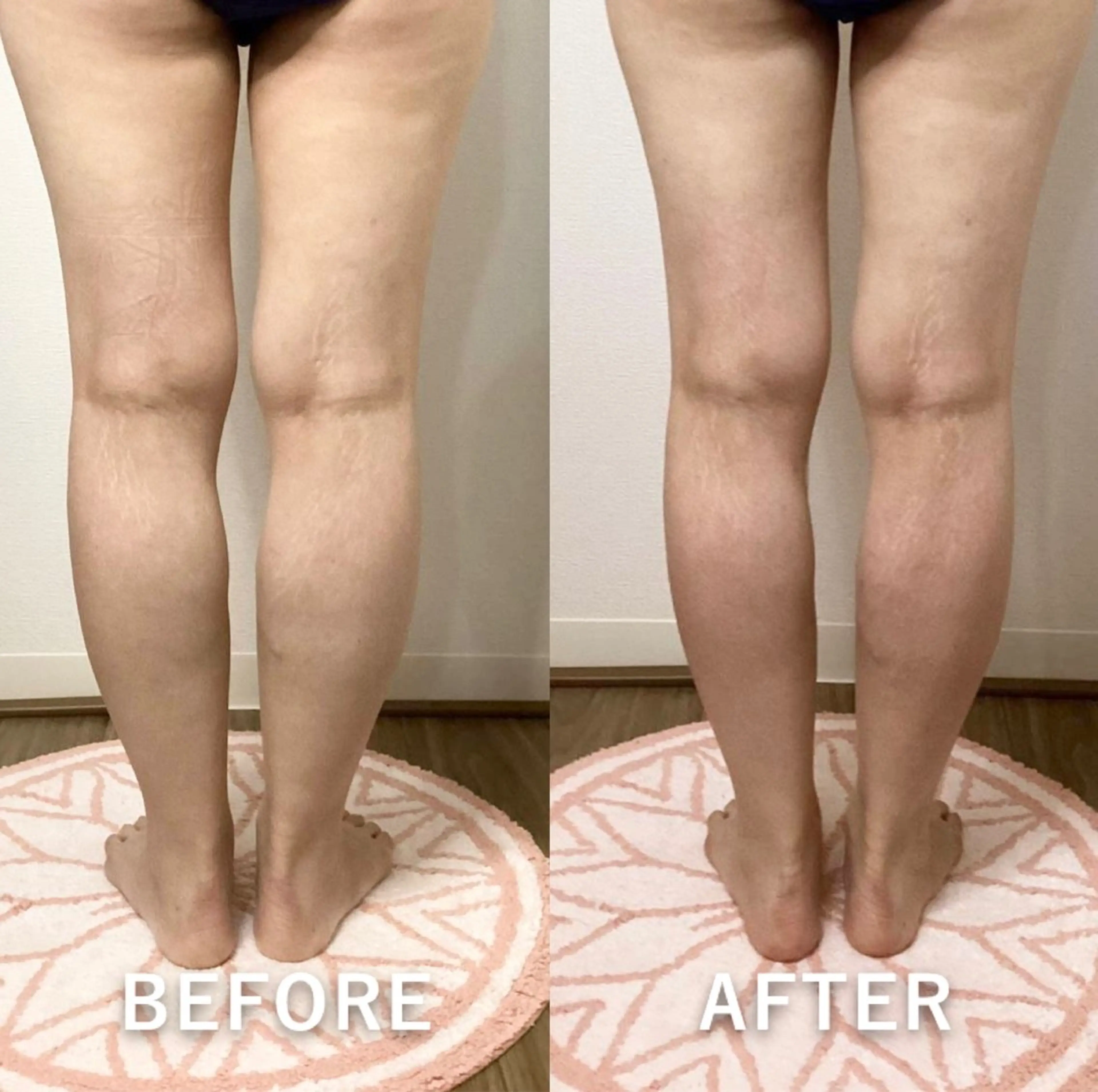 痩身◆ 【美尻/足背面美脚コース】キャビ＋ラジオ派＋痩身マッサージ55分 5500円→の写真