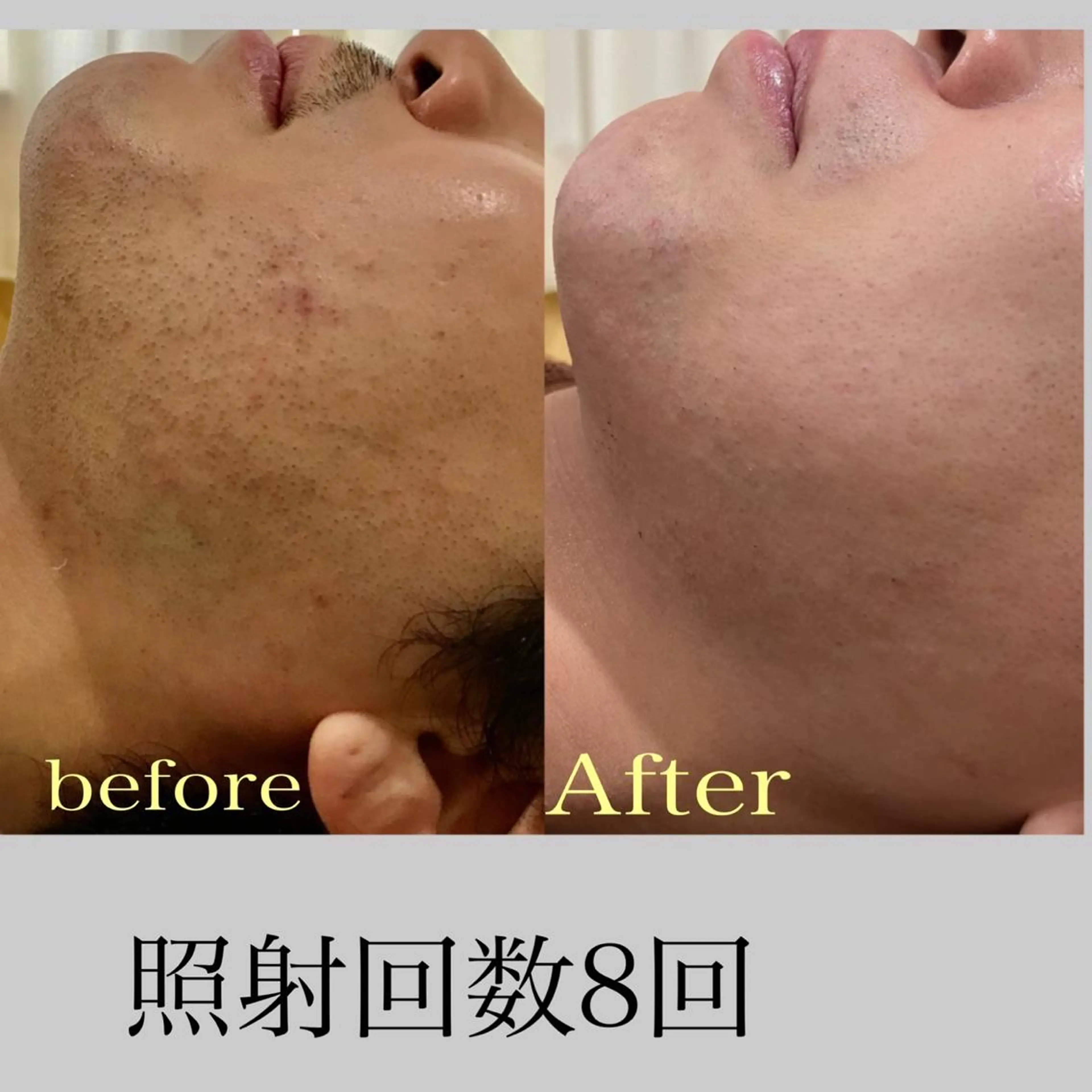 【メンズ脱毛】ヒゲ全体脱毛2回セット✨!朝の時短!お肌の透明感👤の写真