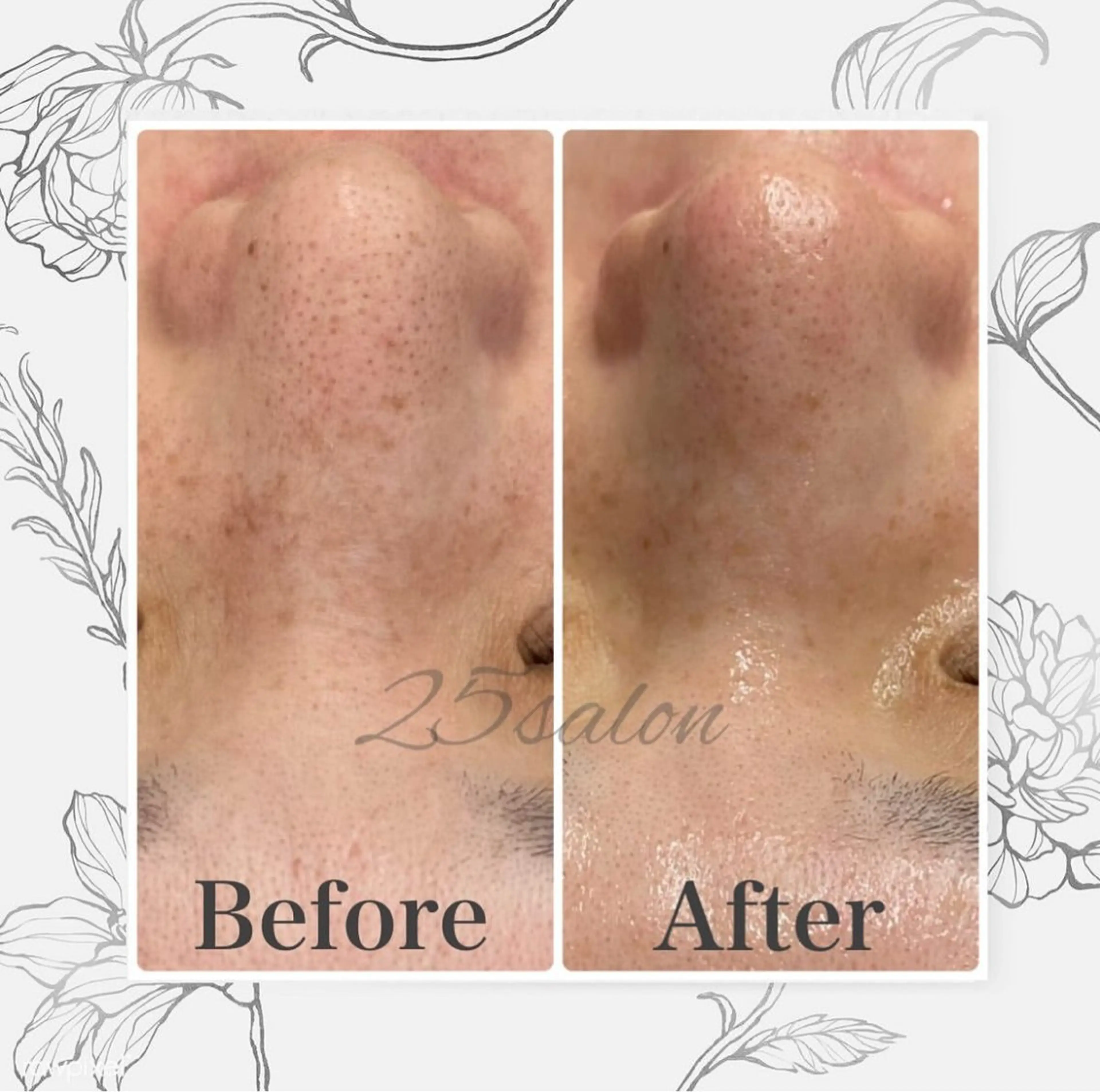 毛穴洗浄の写真