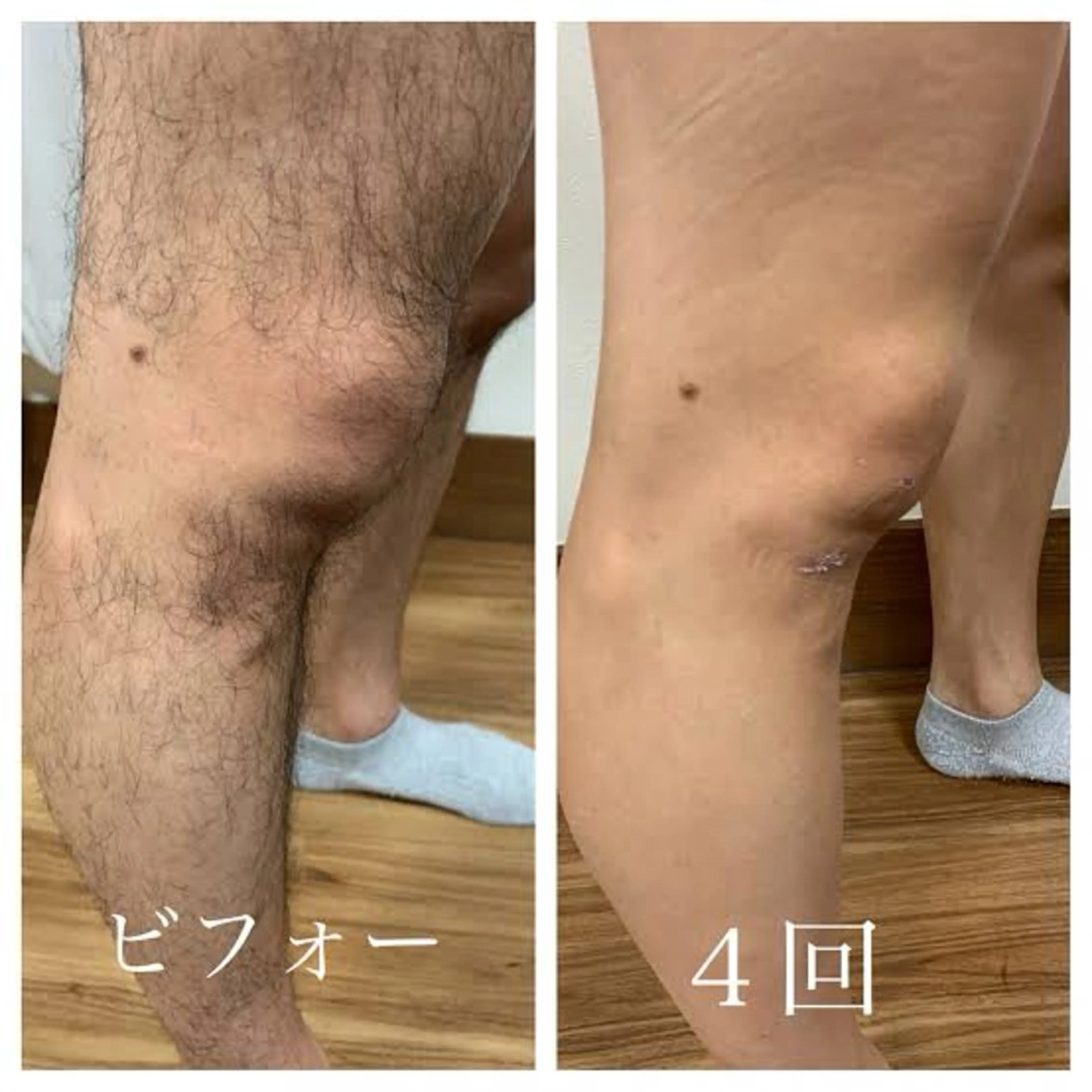 《夏に向けて!》肌質改善+両ヒザ下脱毛 ¥1,000〜の写真