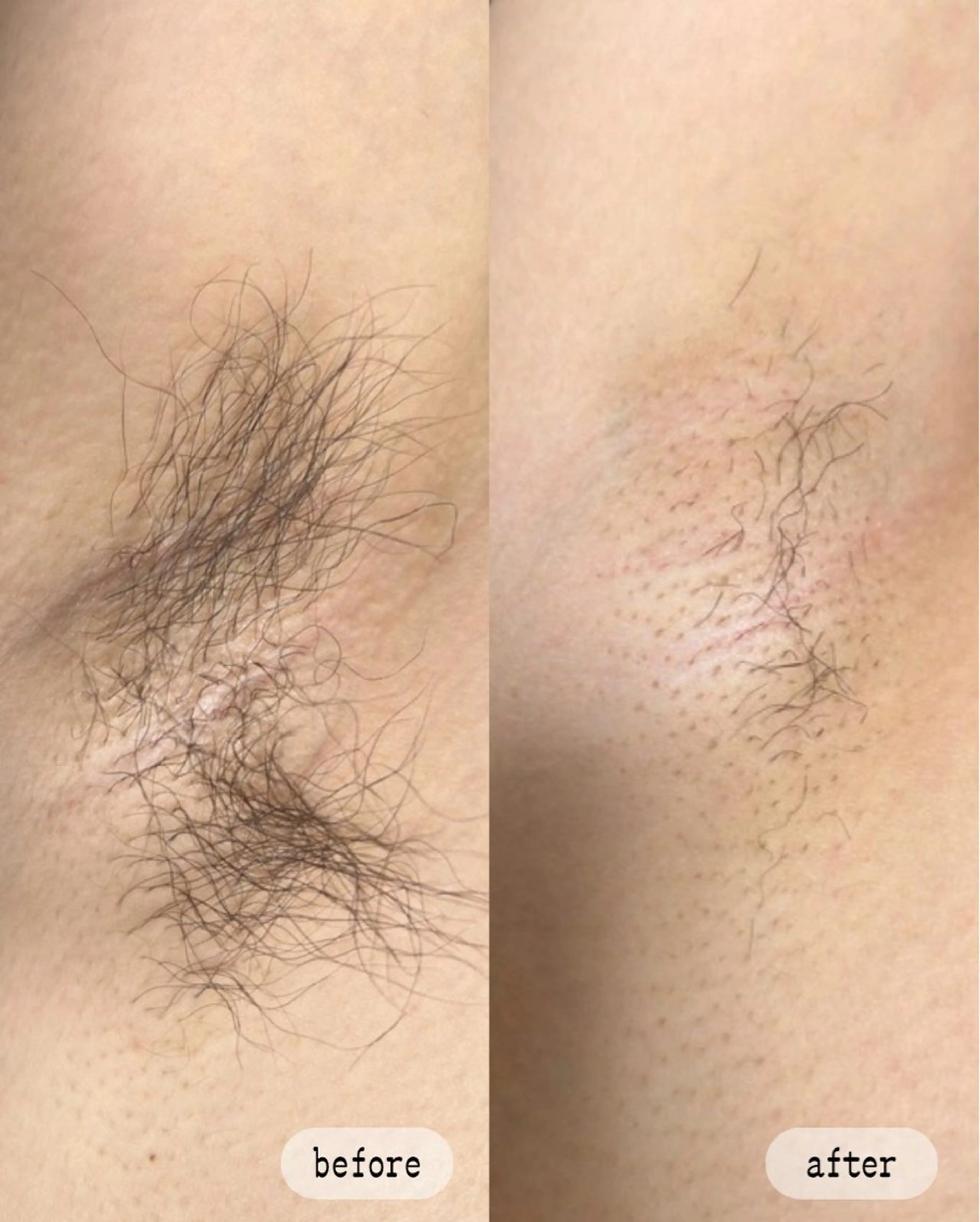 【初回限定】ワキ脱毛（レディース）の写真