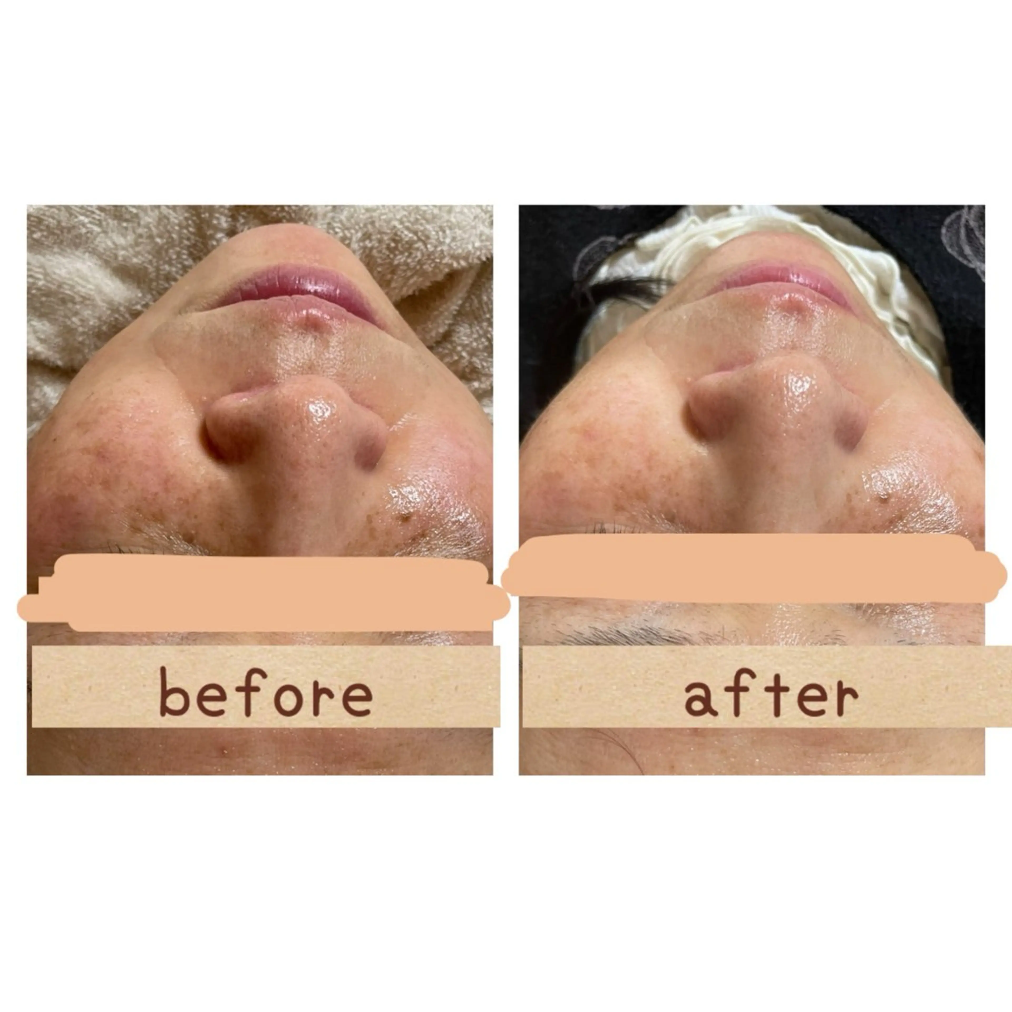 エステ 毛穴洗浄×リンパケア 🫧潤いつるん肌へのエステ・リラクイメージ