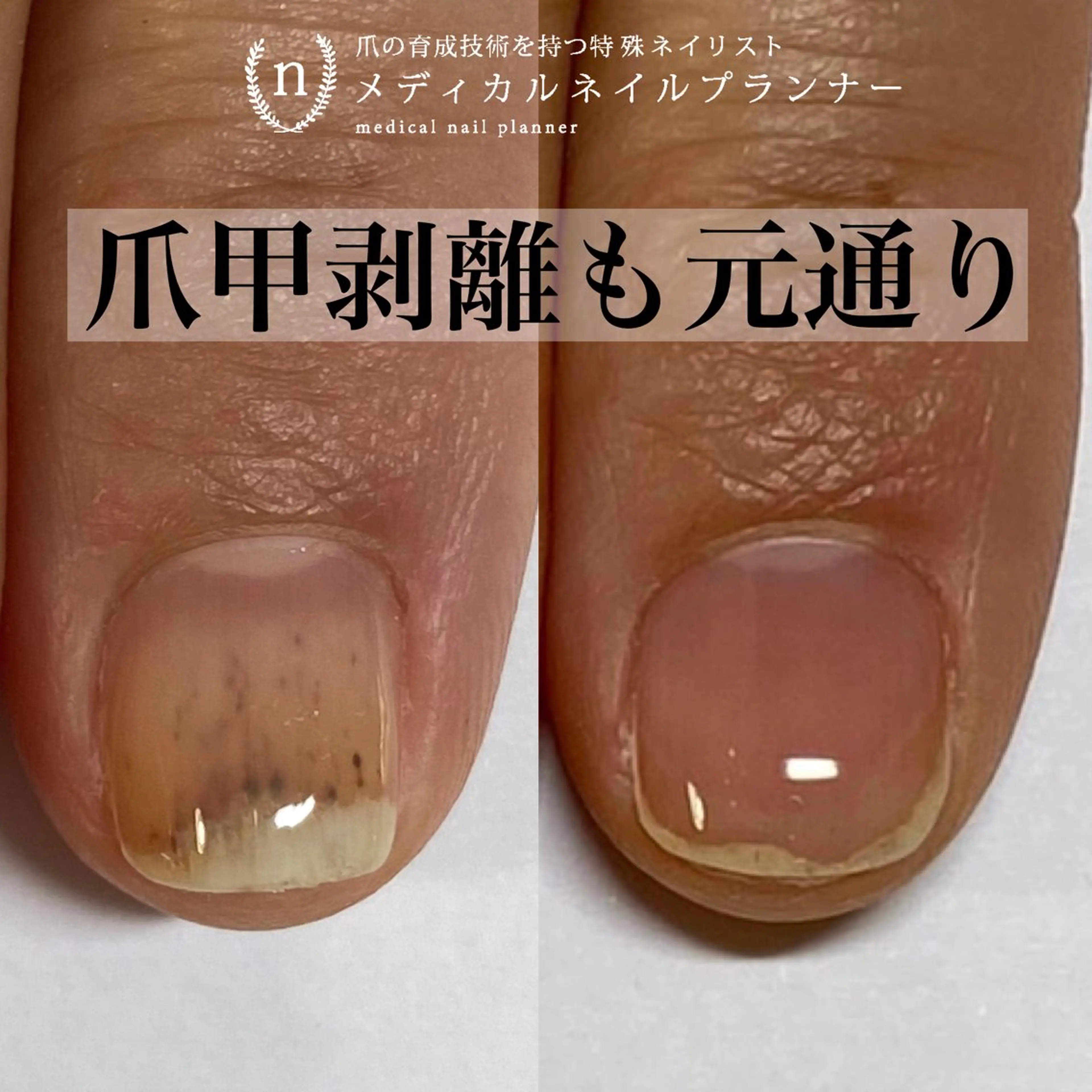 爪甲剥離・トラブル爪対応コースの写真