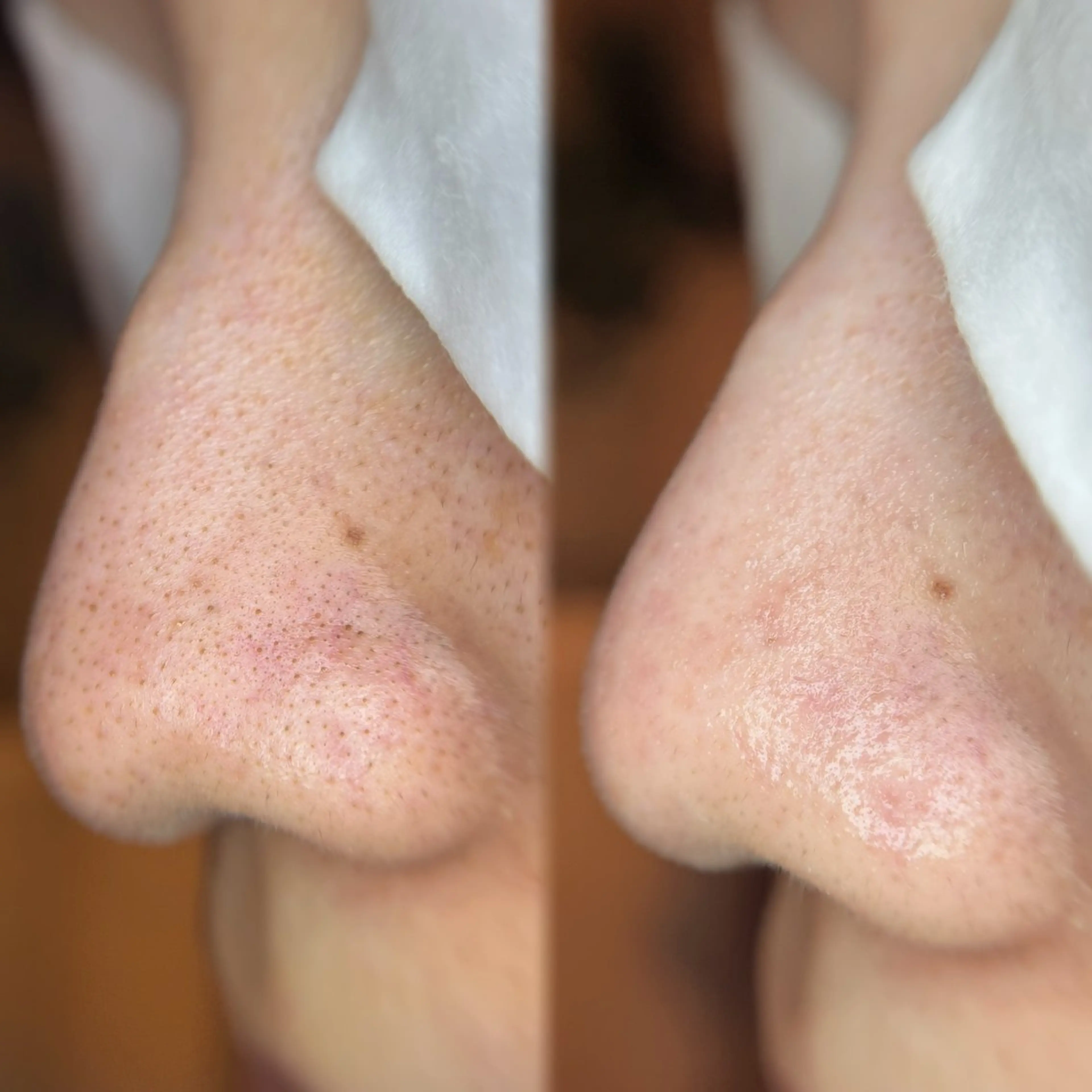 【人気メニューがセットでお得】エクストラクション(鼻)+剥けないハーブピーリングの写真