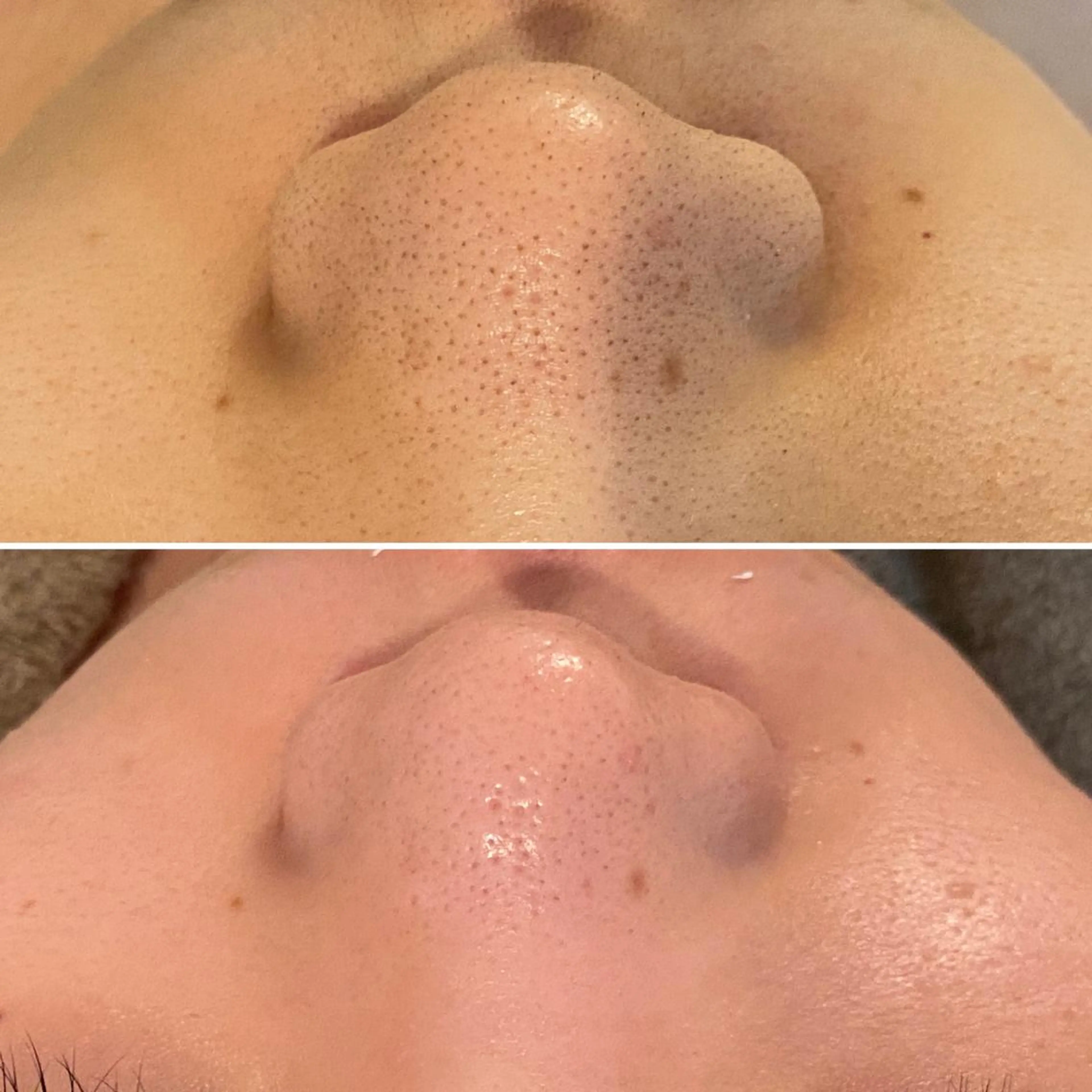 最新【👃肌育毛穴洗浄🌟】美顔器でイオン導出❕当店オリジナル毛穴撲滅コース！の写真