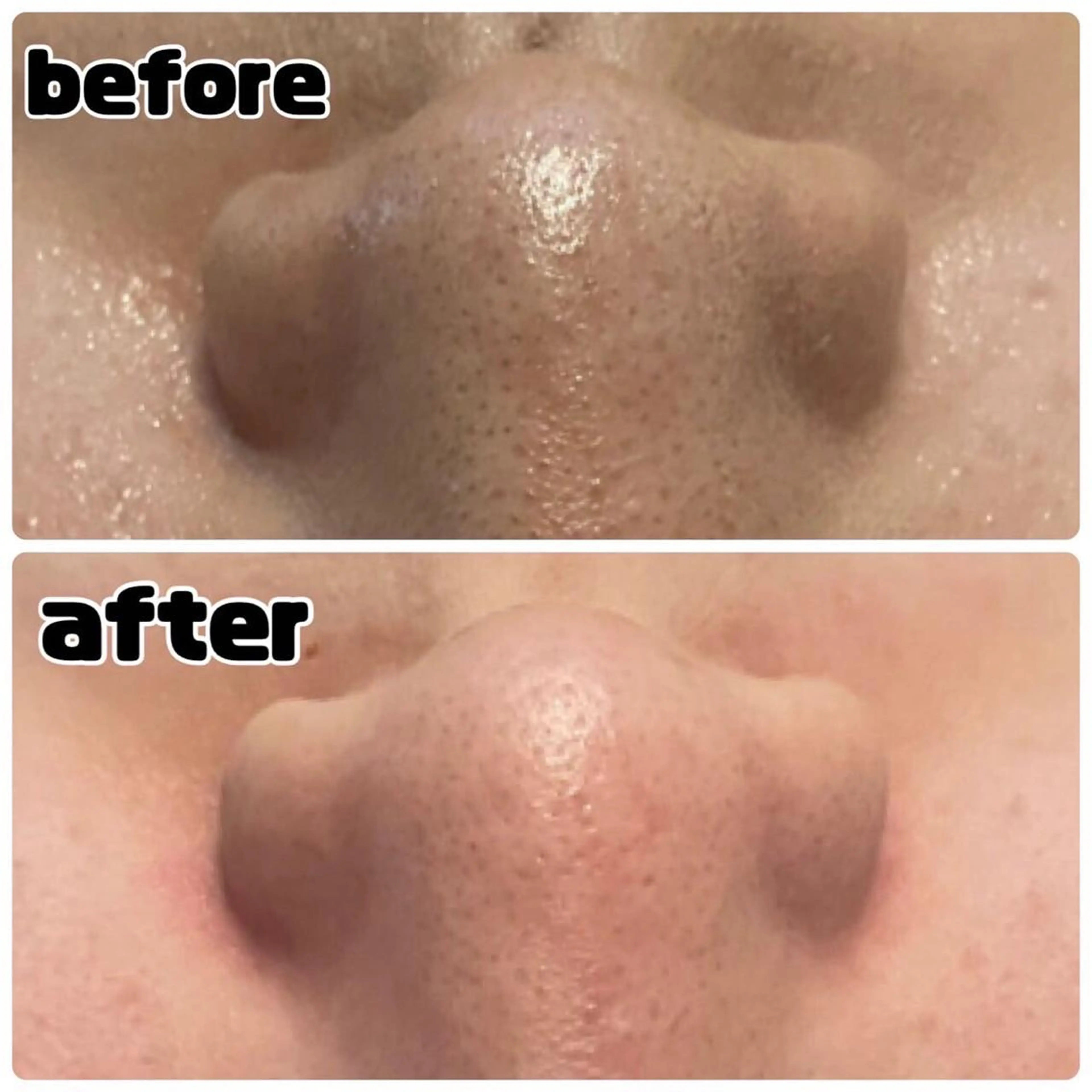 【4/14限定✨ご新規様限定】毛穴の角栓ごっそり撃退コース ¥13,200→¥2,980の写真