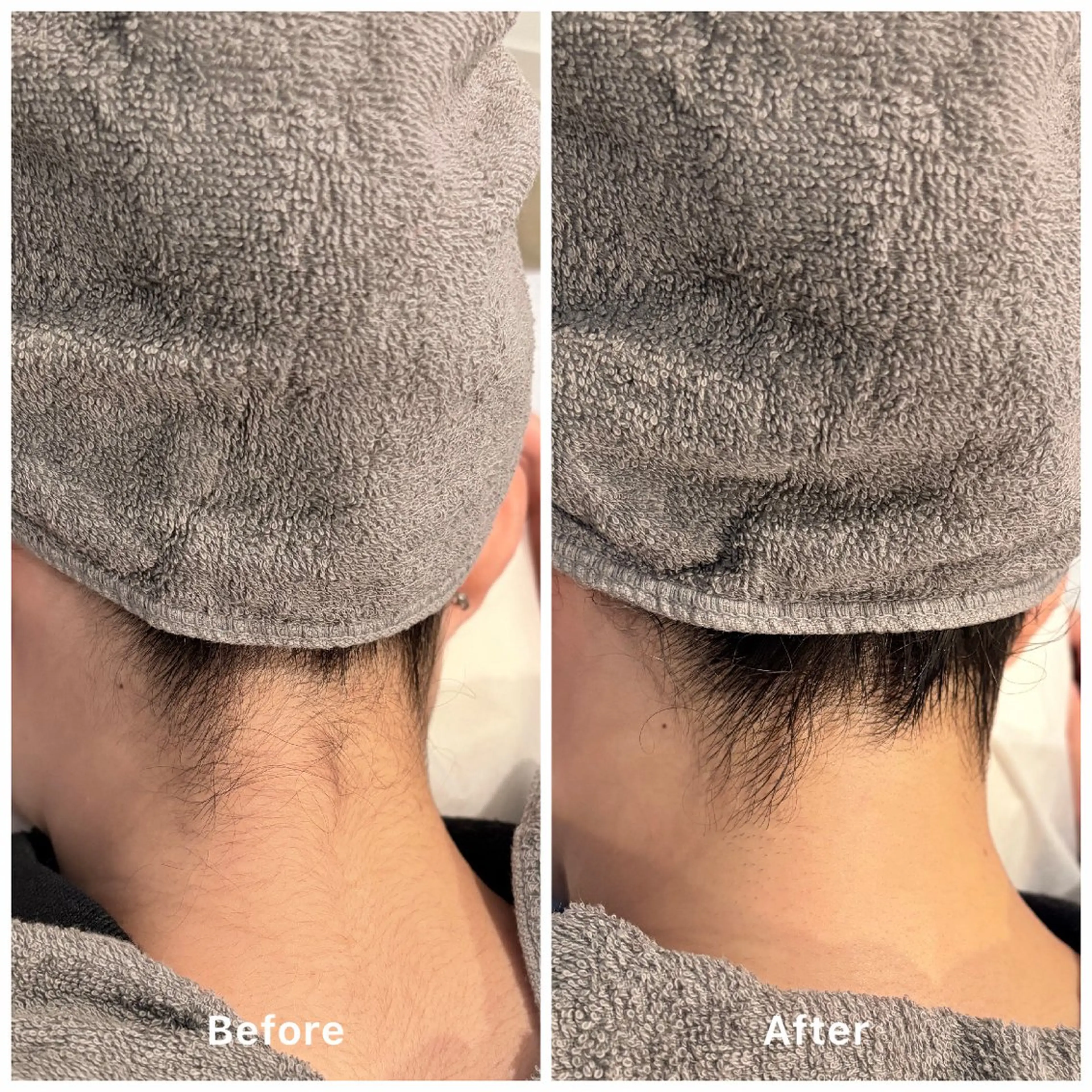 キレイなお姉さん✨うなじ脱毛✨の写真