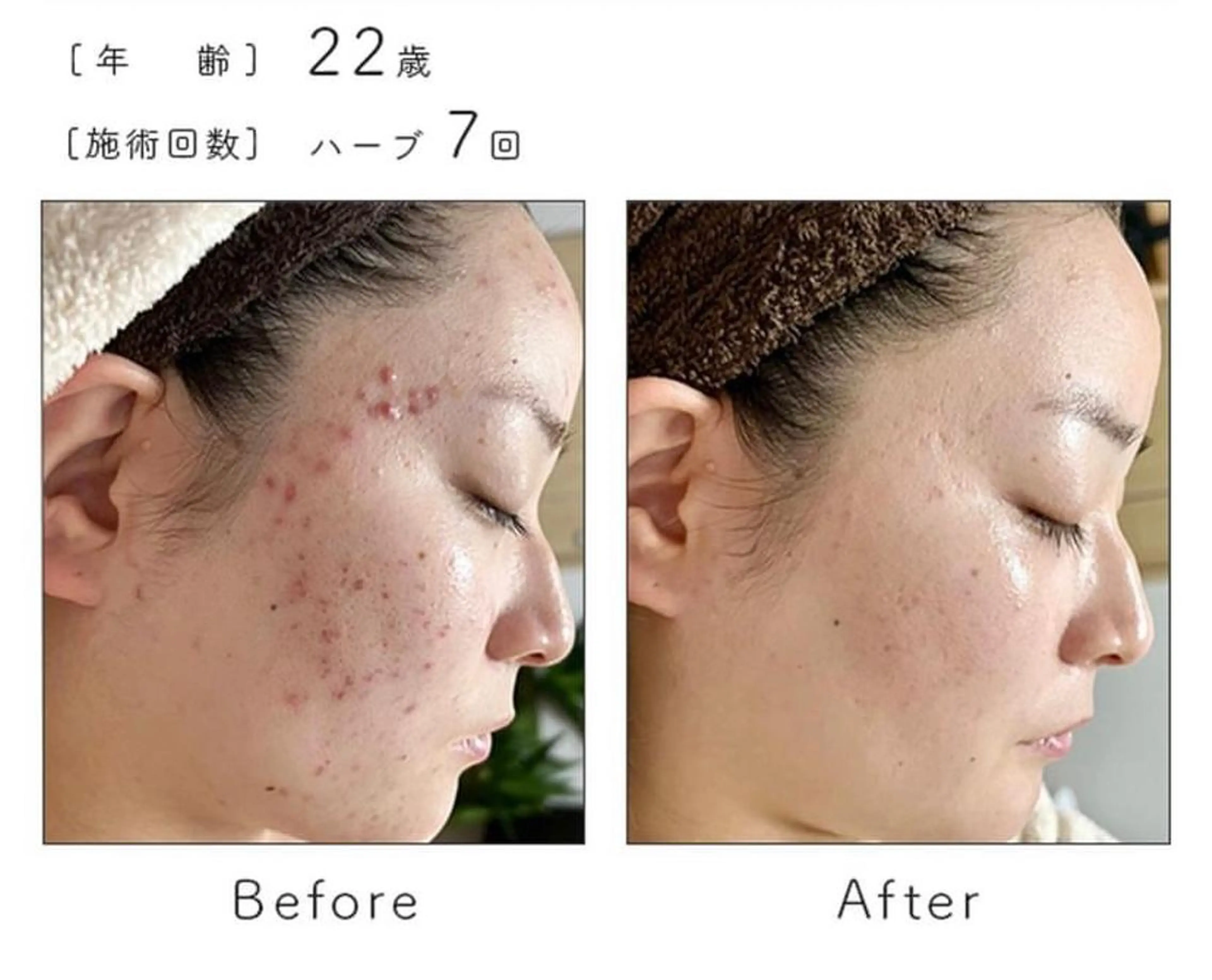 エステ ハーブピーリング専門 BIOPLUS+川崎のエステ・リラクイメージ