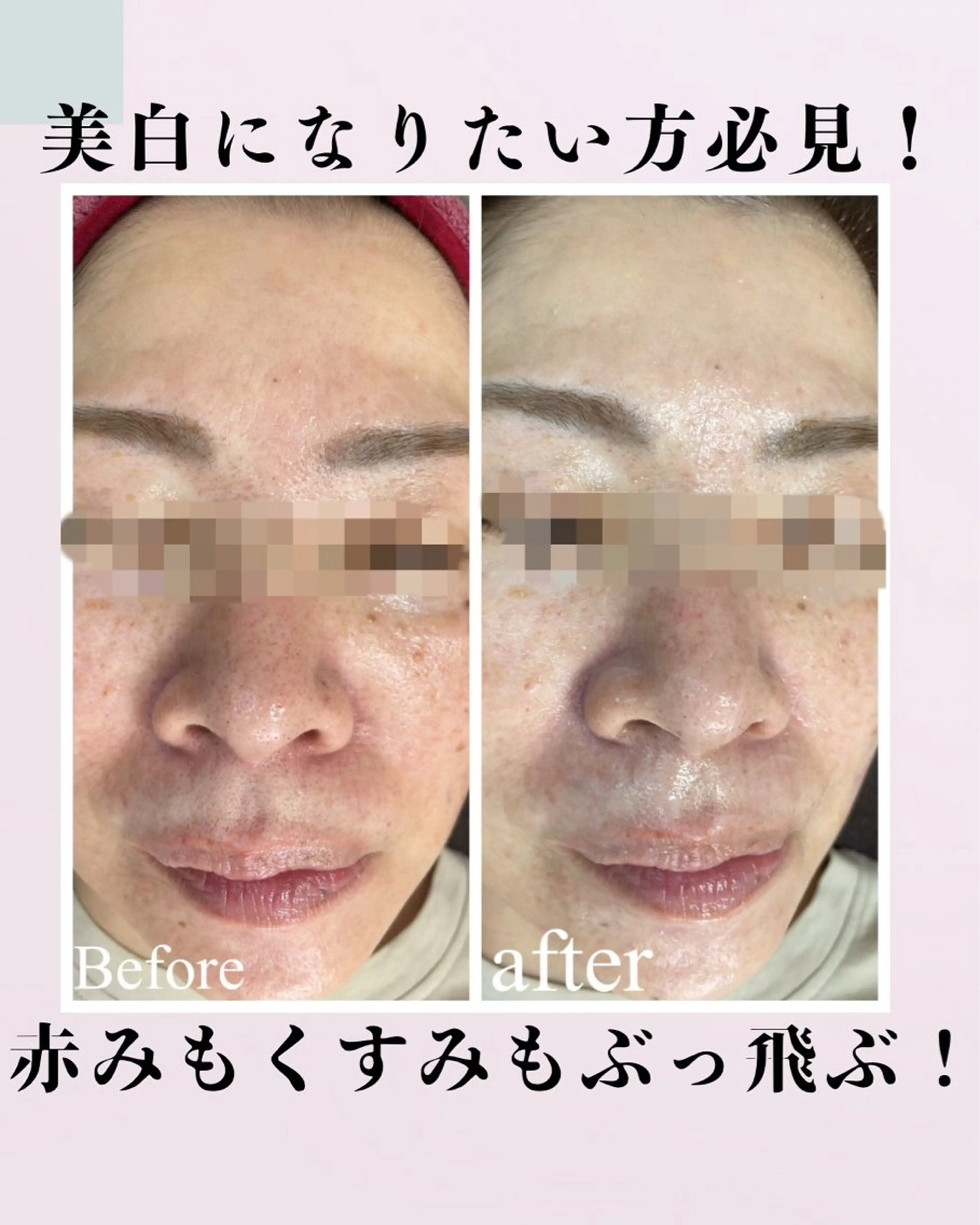 平日限定！　毛穴ケア　肌引き締めコースの写真