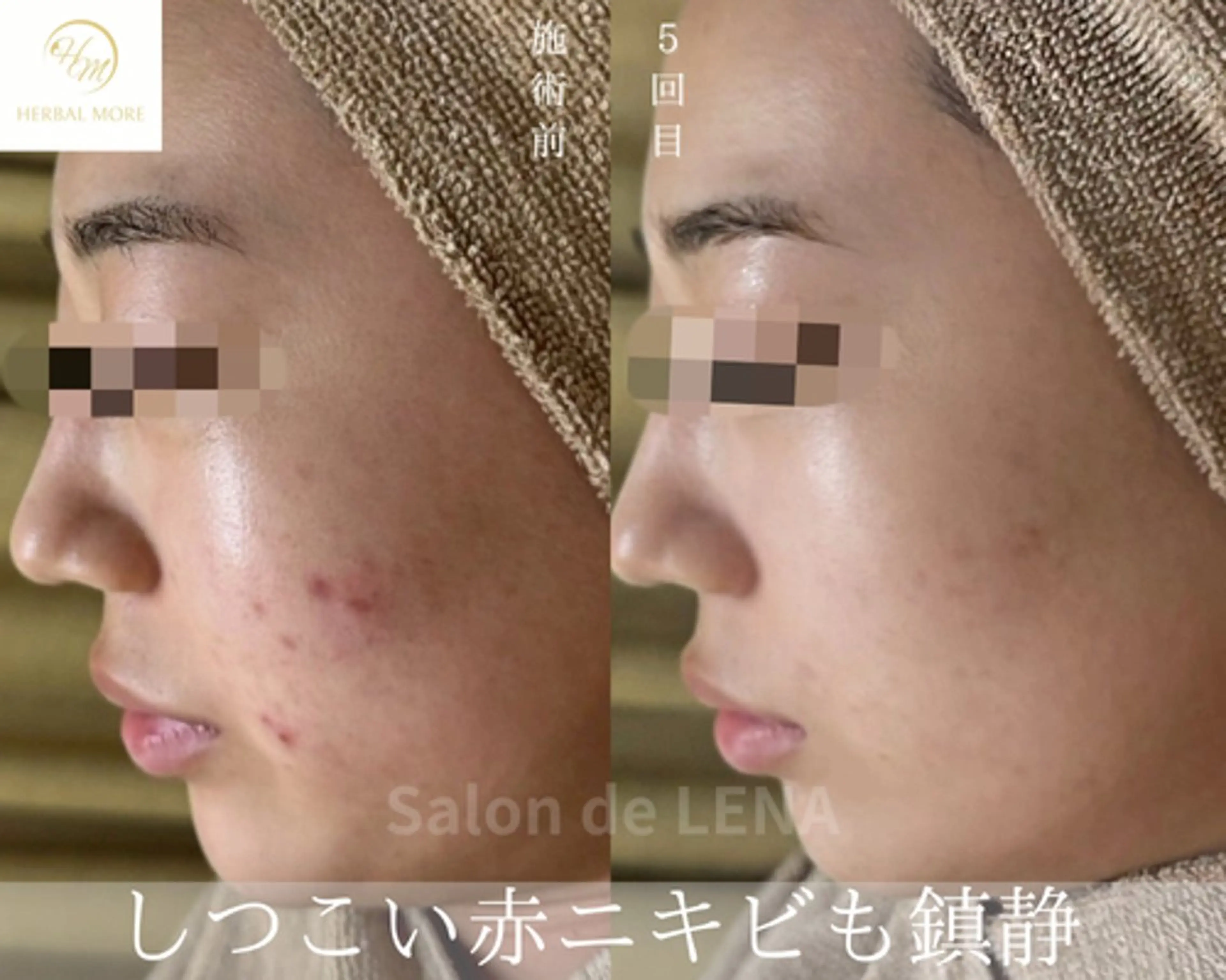 ハーブピーリング・毛穴ケア専門サロンSalon de LENA 栄店所属・ハーブピーリング専門 サロンドレナ　白藤のエステ・リラクイメージ