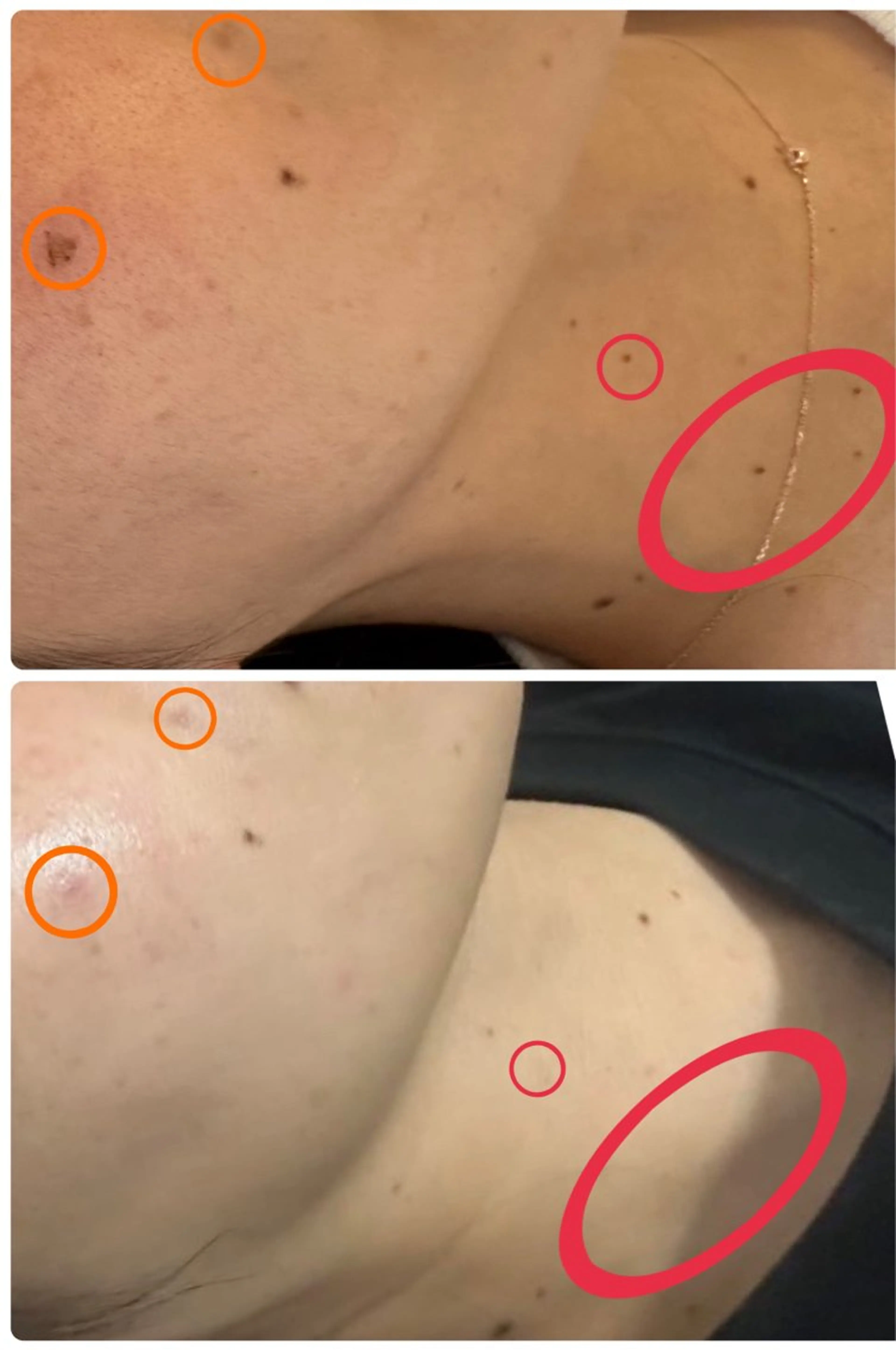 📣低周波のシミケア💎(シミ•イボ•ホクロ対応)1か所¥500⭐️カウンセリング必須(¥0)の写真