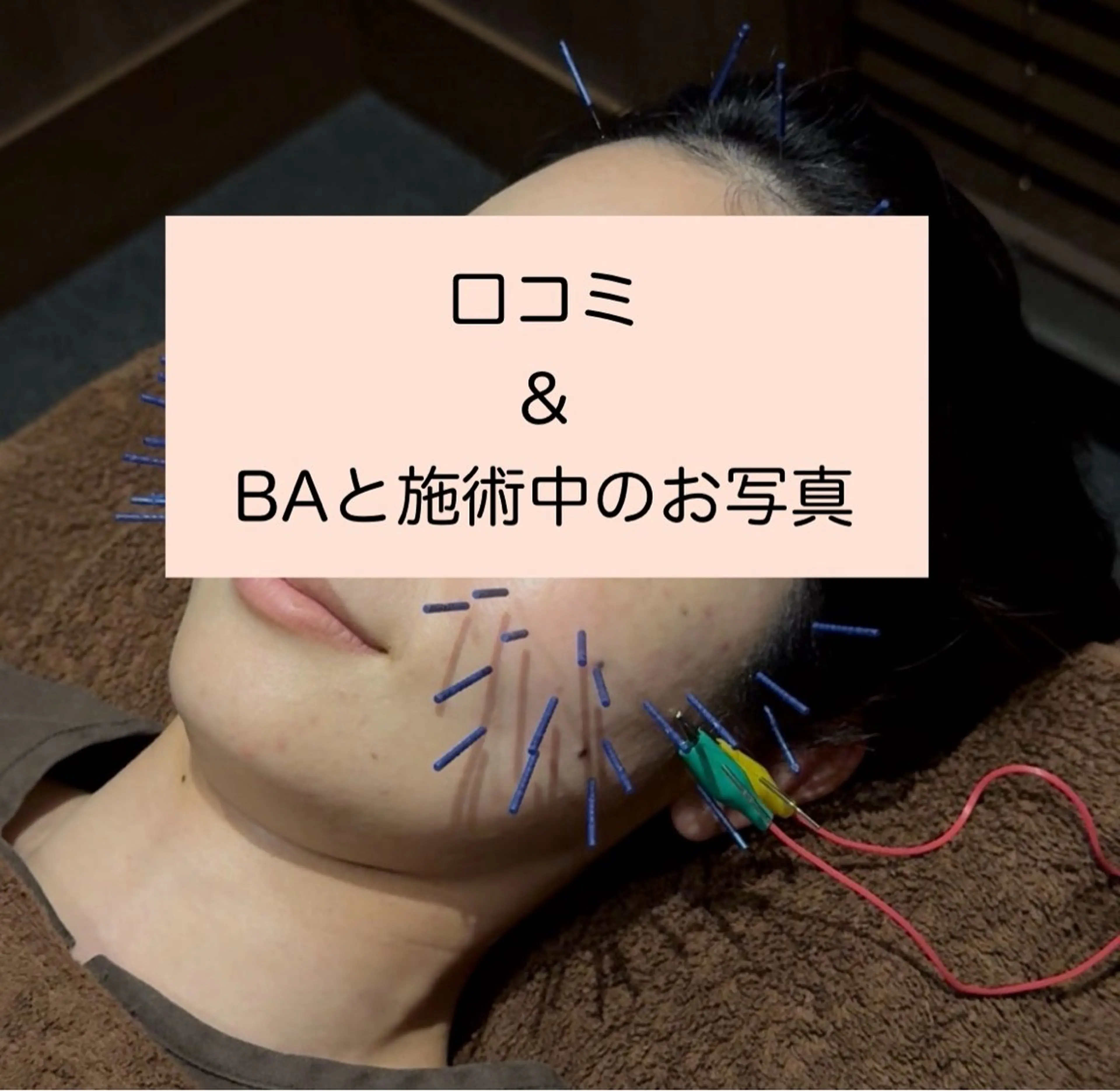【初回限定】お試し美容鍼(カウンセリング＋施術30分)の施術中のお写真掲載OKな方＆口コミいただける方✨️10名限定‼️の写真