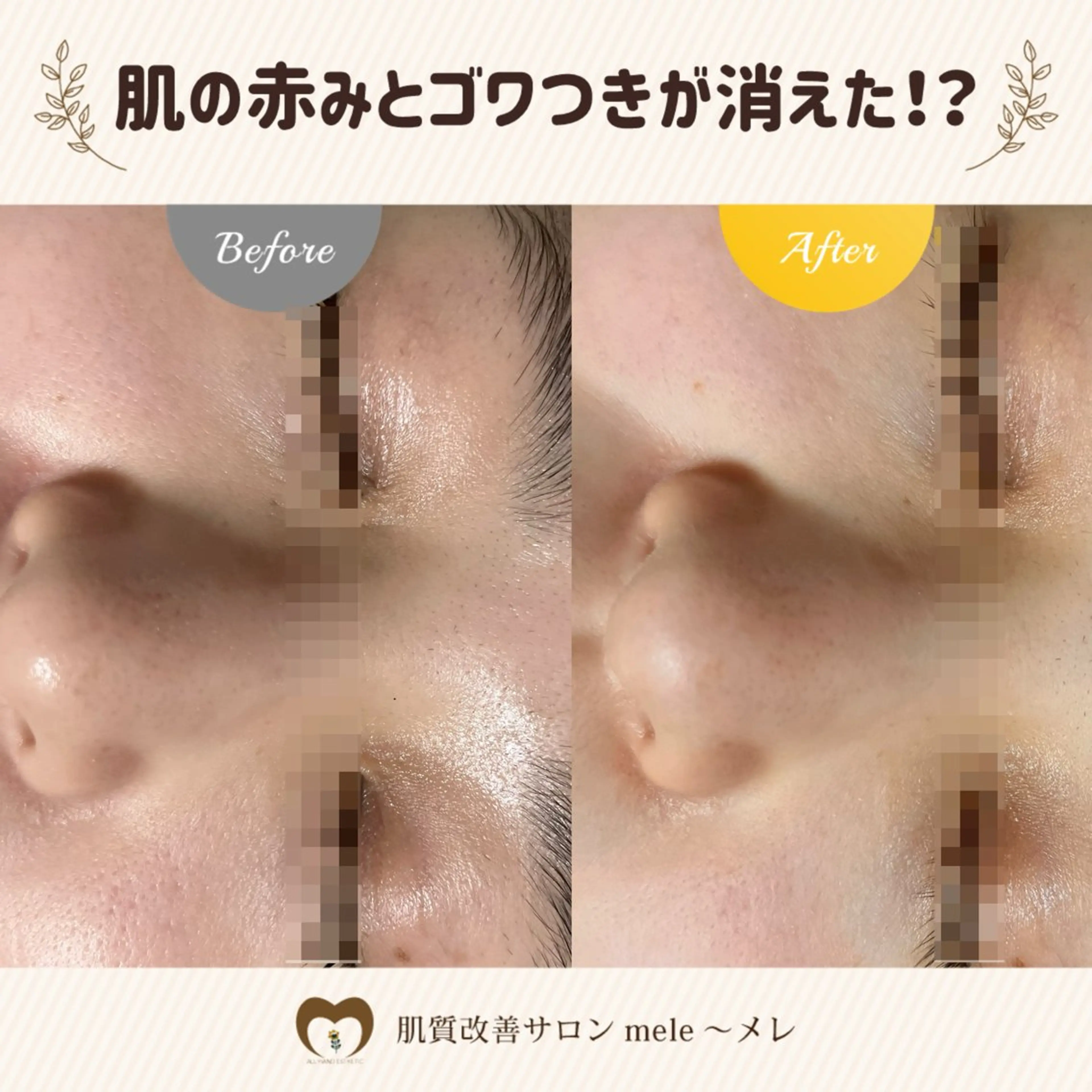 繰り返すニキビ・毛穴 ✨つくば肌質改善専門のエステ・リラクイメージ