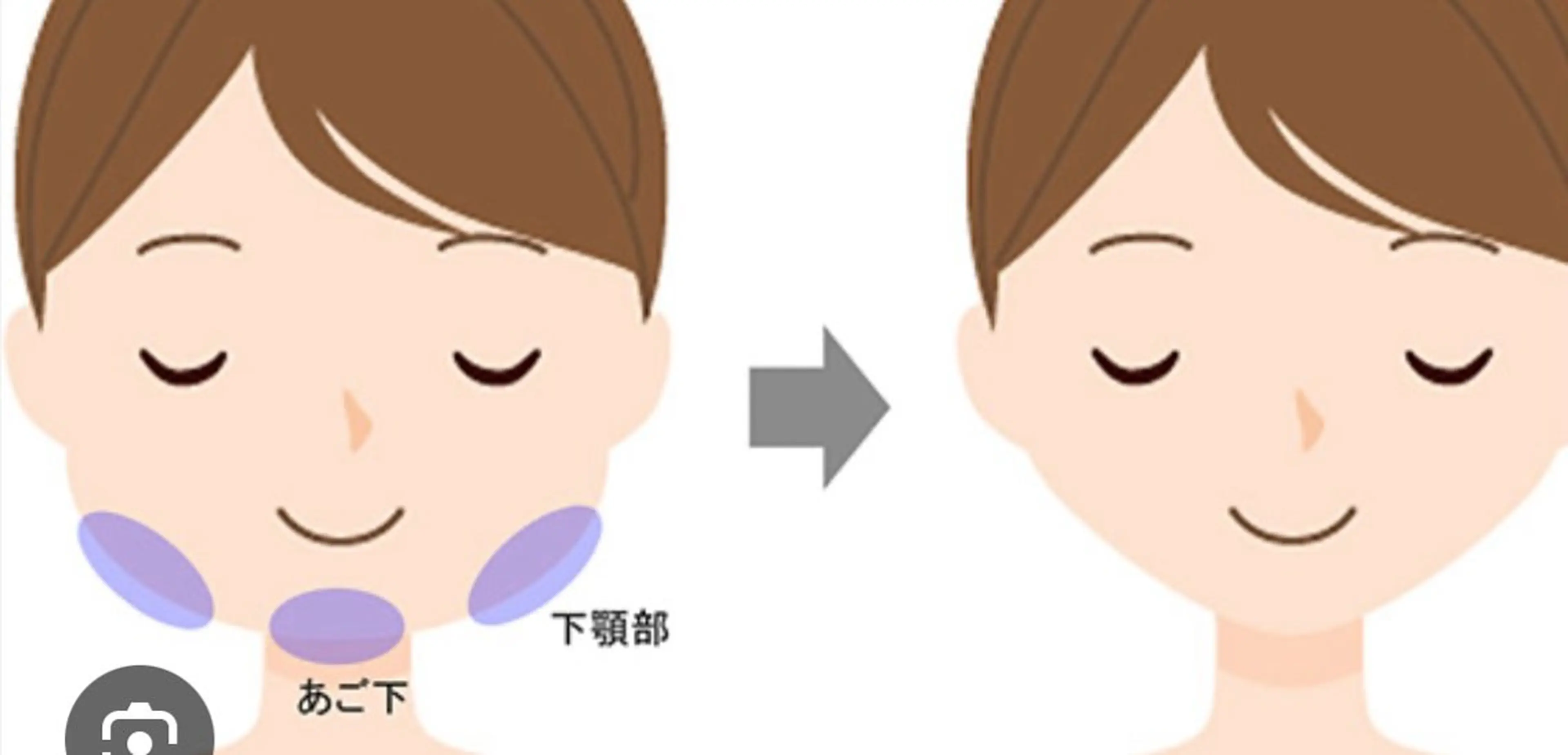 刺さないメソセラピー(脂肪減少)二重アゴなどお顔の脂肪やたるみにお悩みの方に。の写真