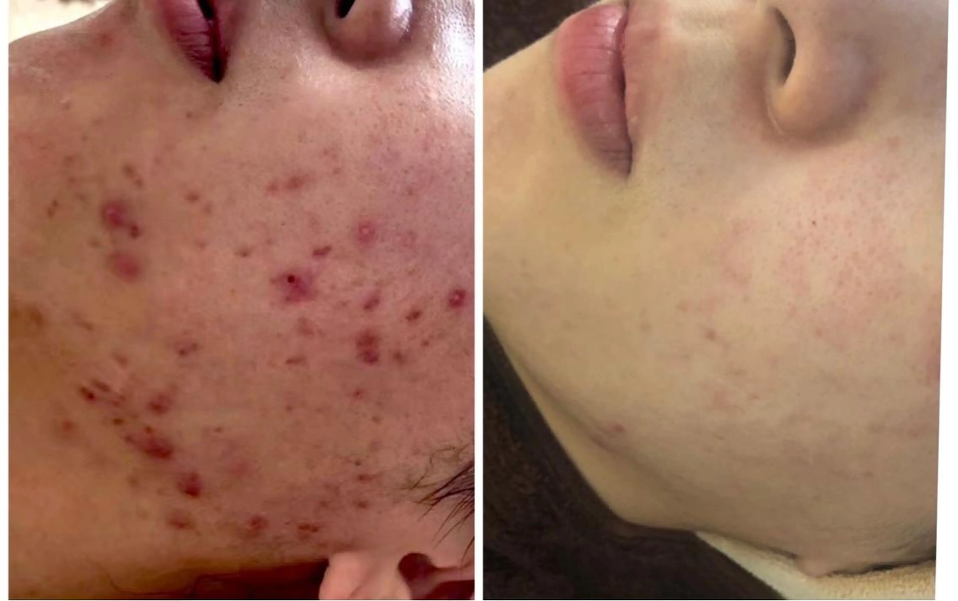 エステ フェイシャル専門 肌質改善/プランスのエステ・リラクイメージ