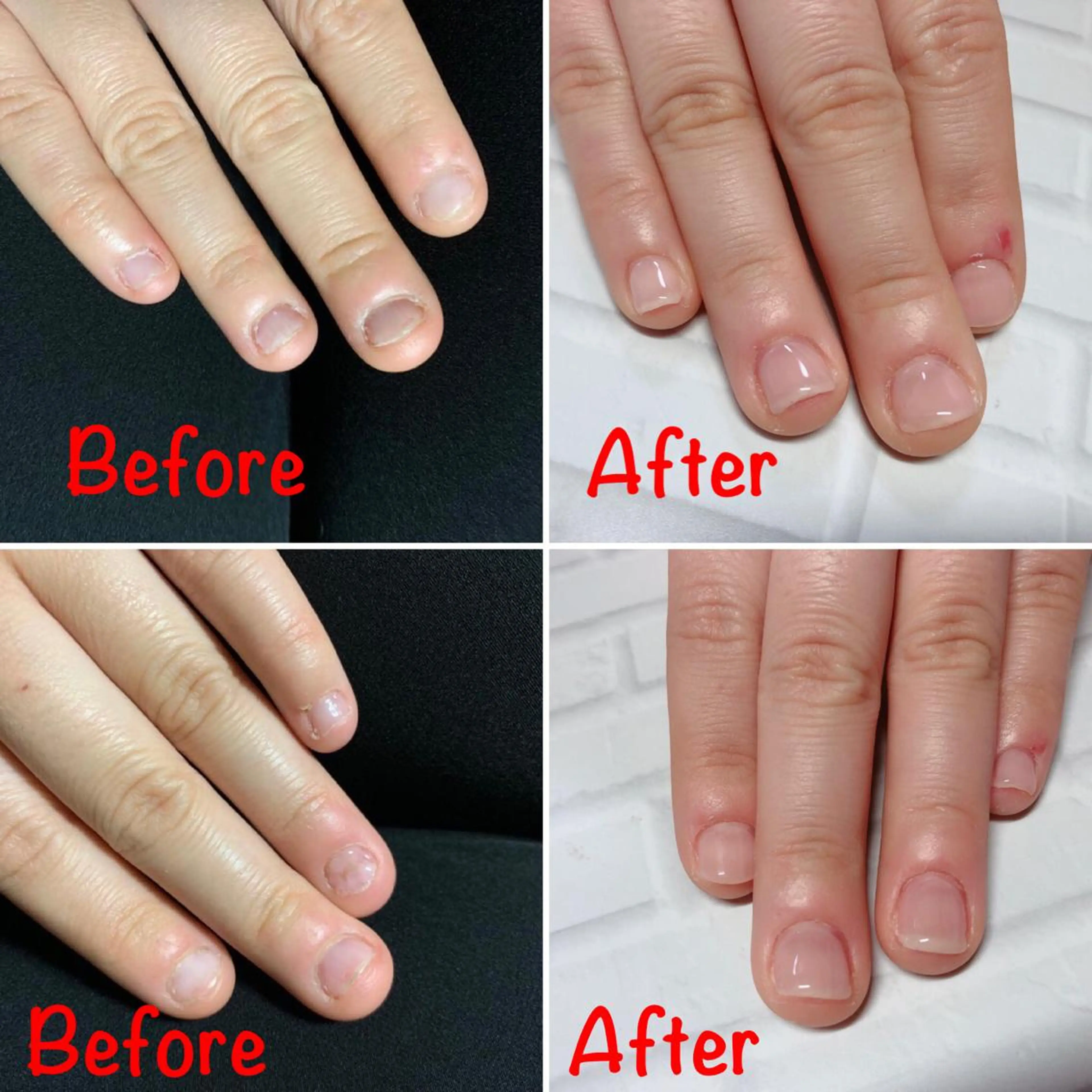 【深爪・育爪❤】伸ばす➕強化➕デコボコを　3ヶ月コース ツルンと美爪に💅🏻の写真