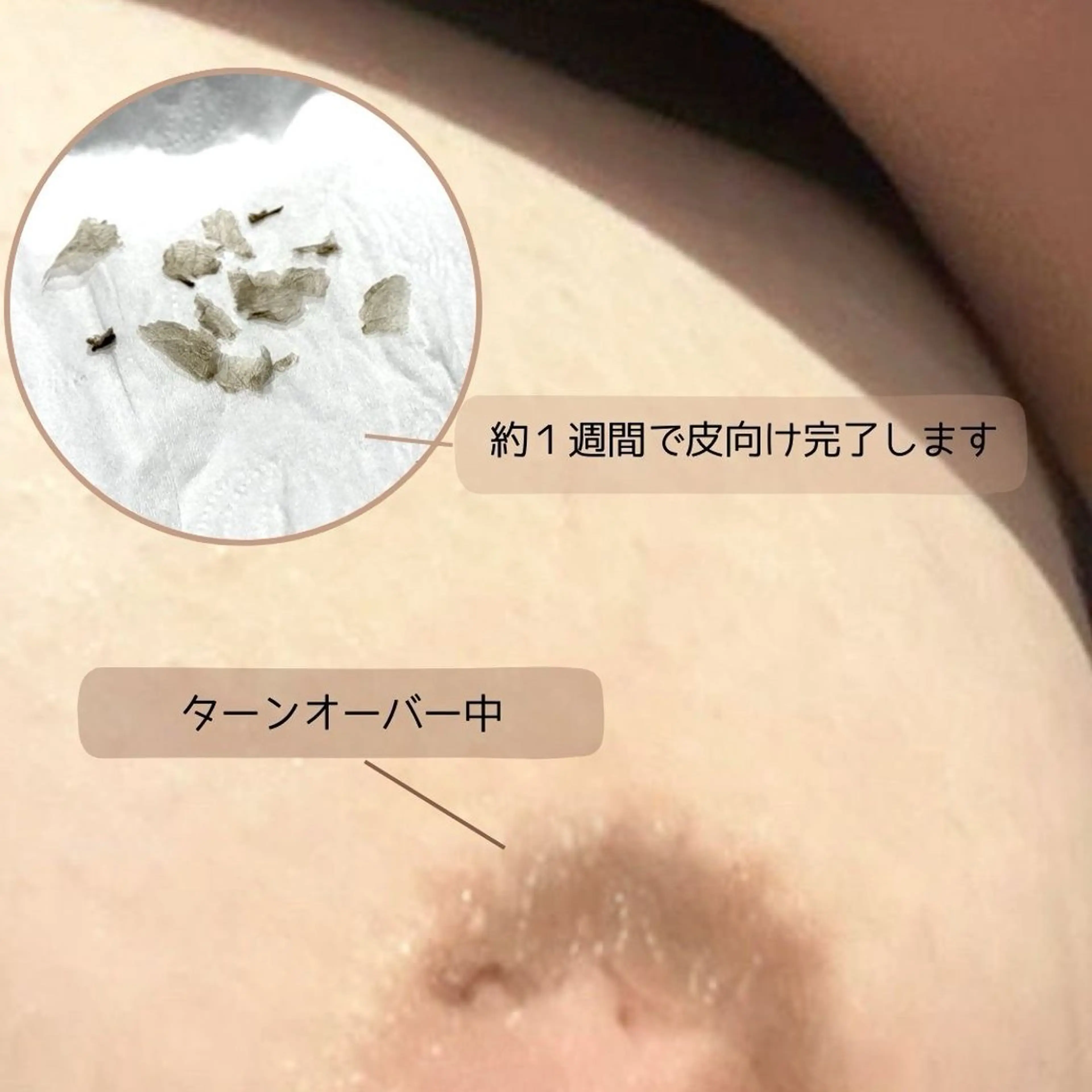 話題の最新黒ずみ除去【ローマピンク・乳輪乳頭】 モニター募集中!!40%オフの写真