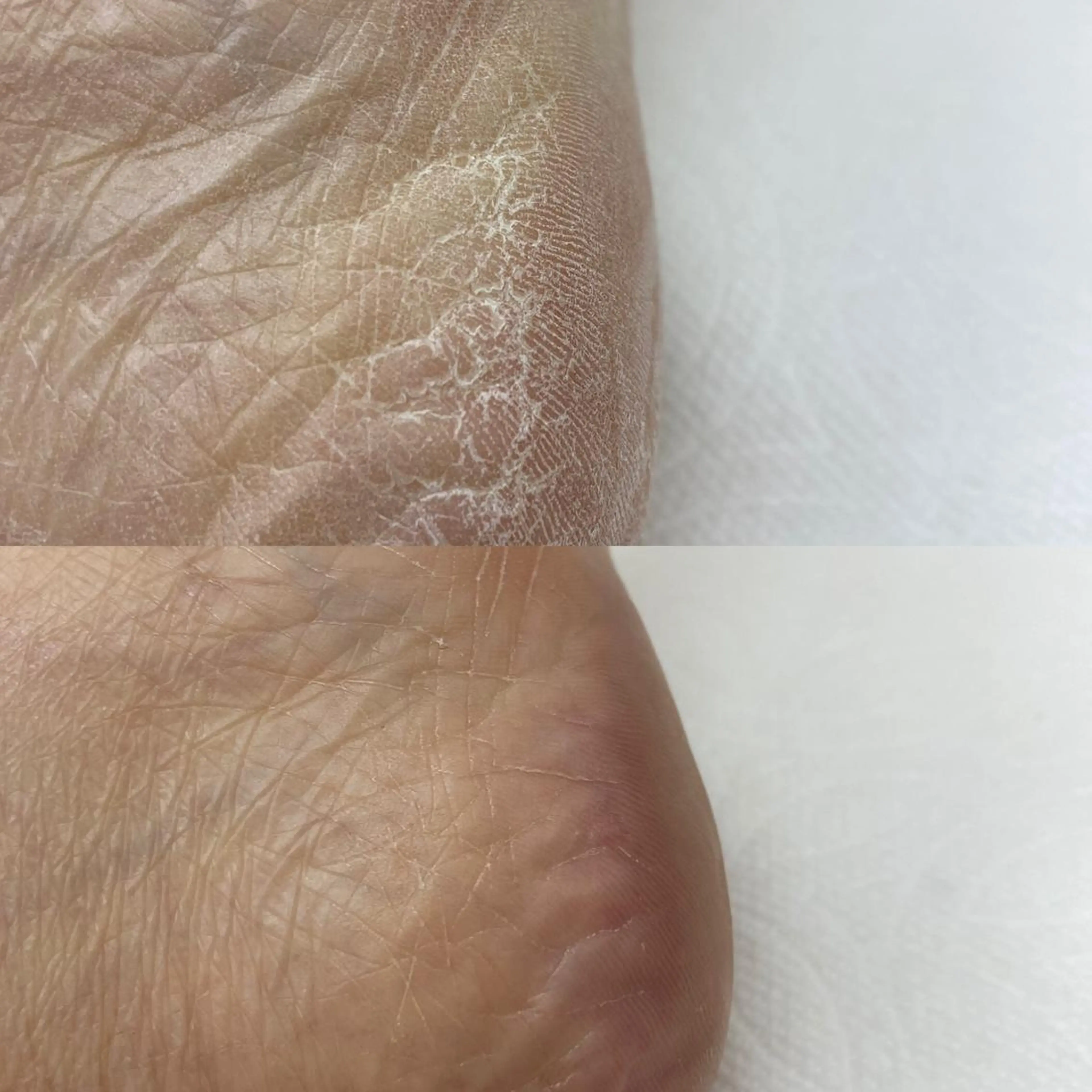 フット角質ケア✨👍ツル肌に！他メニューと一緒で4400円の写真