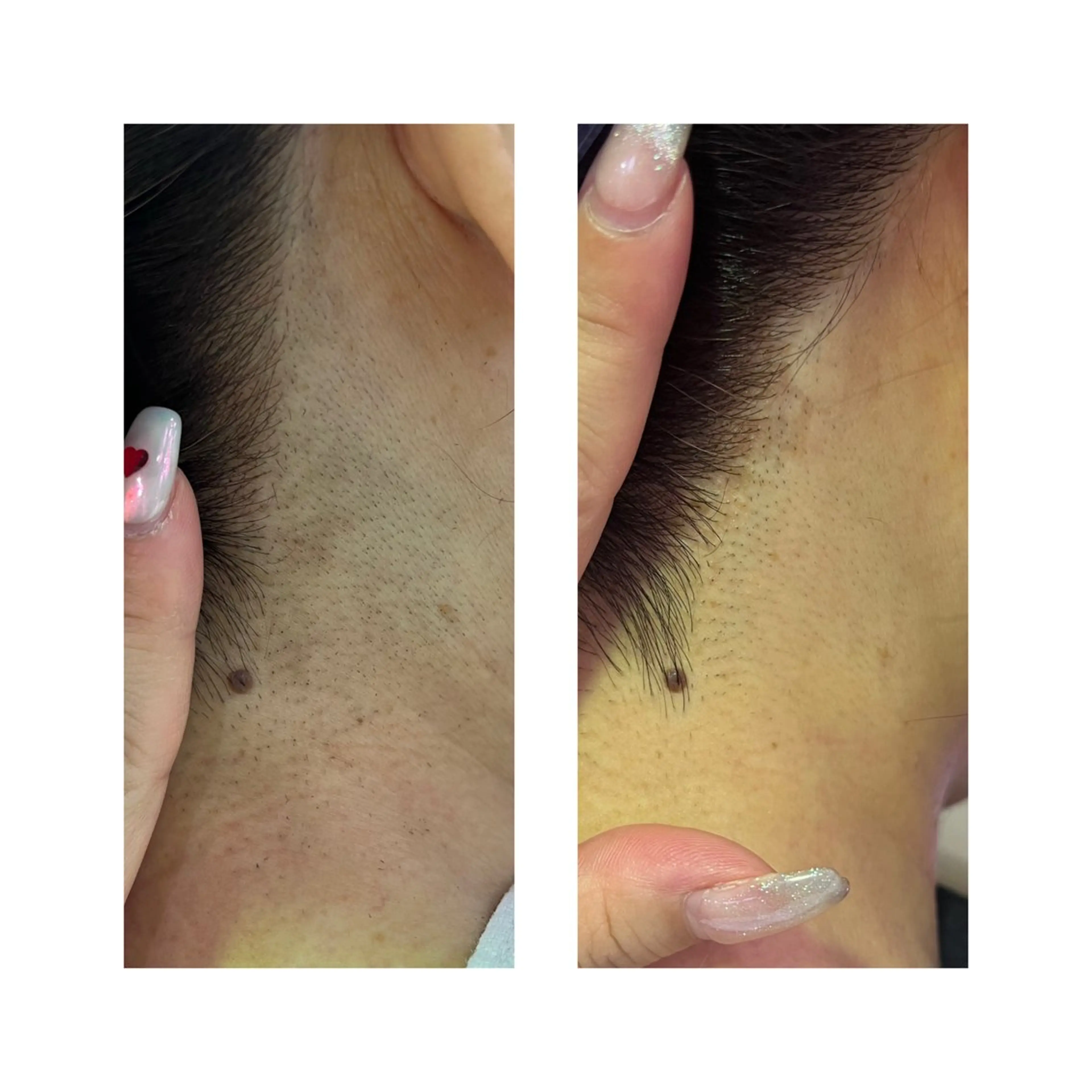 💎うなじ or お顔(ヒゲ可)脱毛の写真