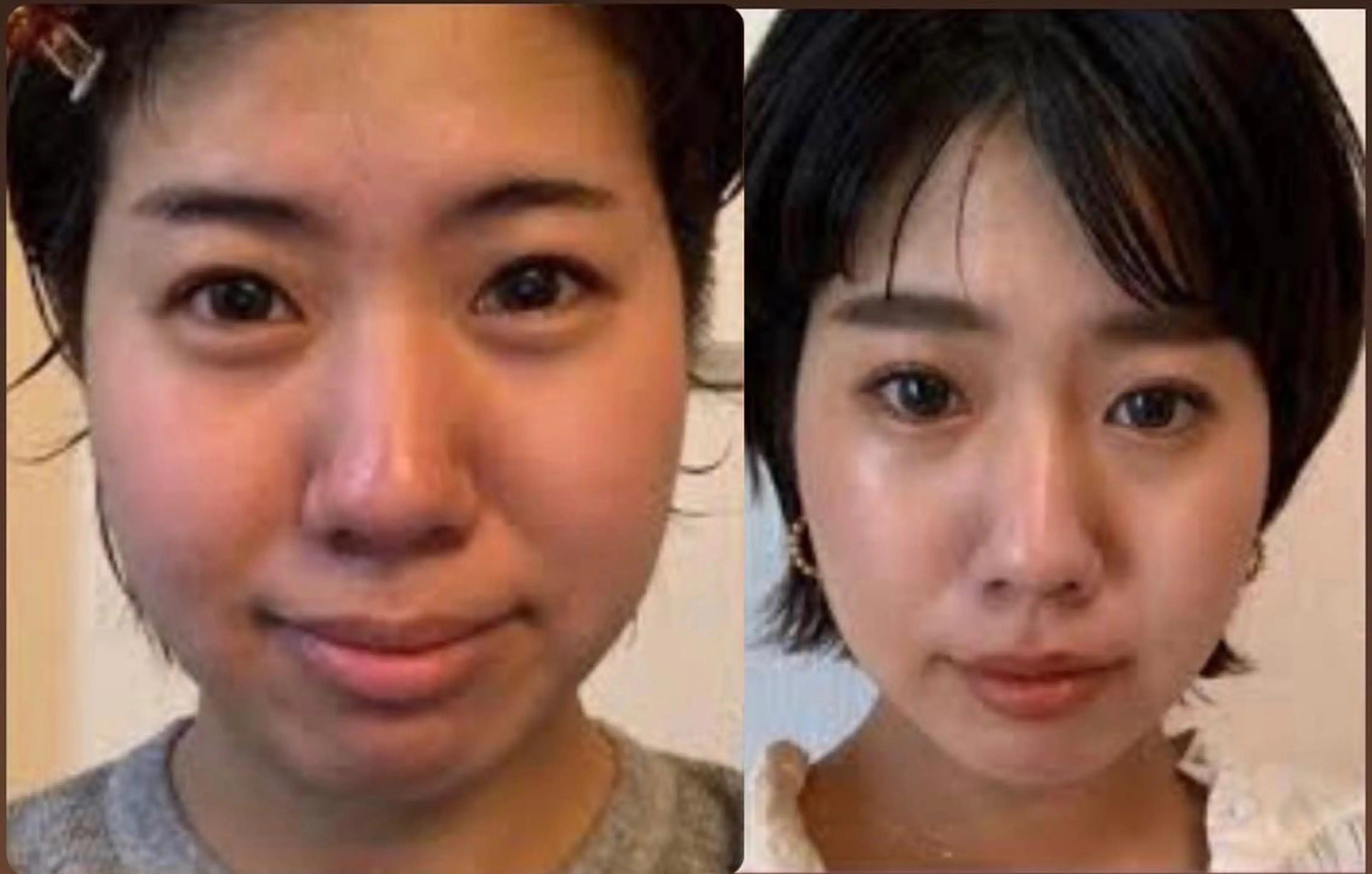 最速最強小顔💆🏻🫧🔥コルギ＆はいふ超えの医療美容機器で、筋肉を和らげる事と、鍛える事を同時施し、最強の小顔へ🔥の写真