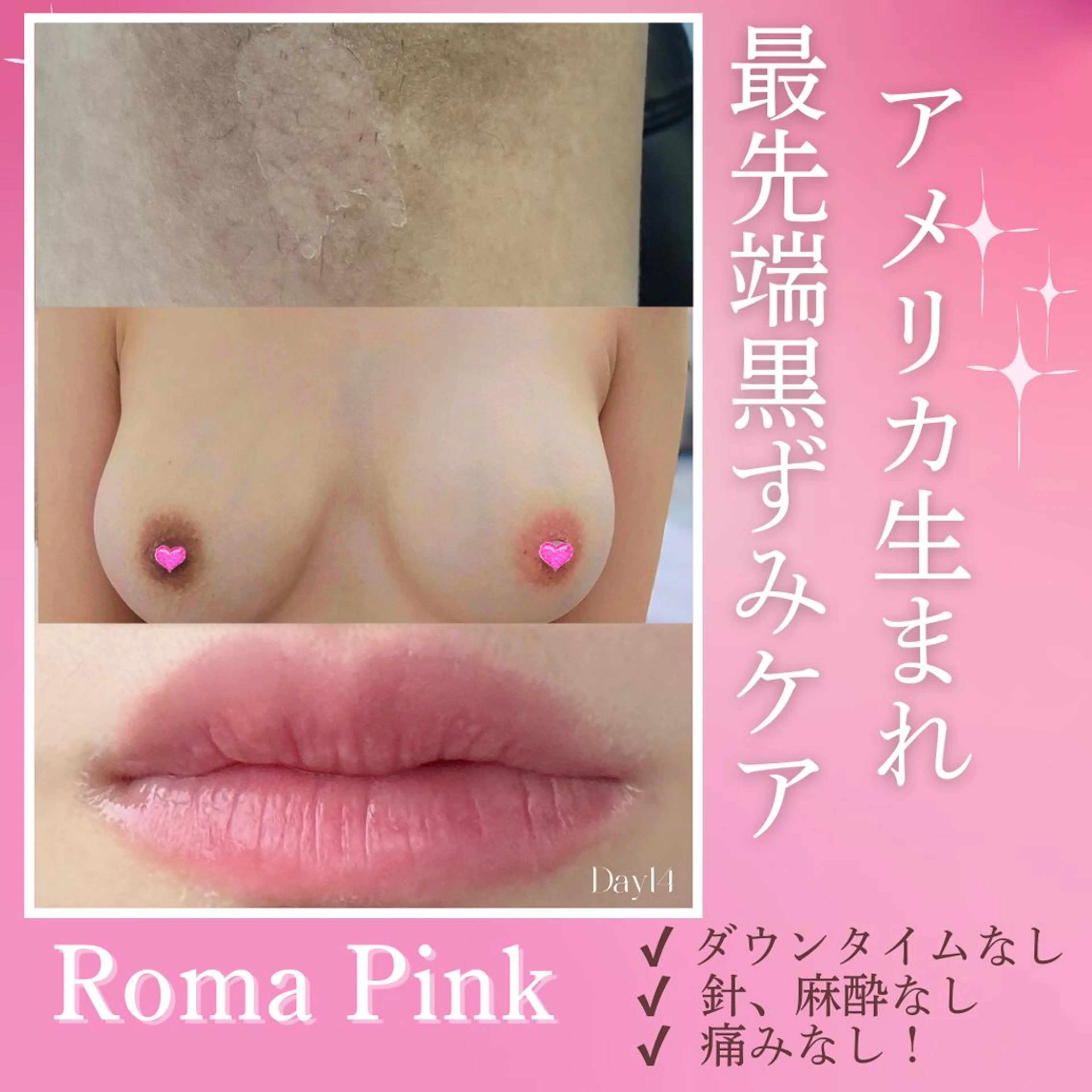 【大人気👑ローマピンク🩷今月特別案内あと3名】気になる黒ずみ悩みはまずカウンセリングへ♪特別プレゼントあり💝の写真