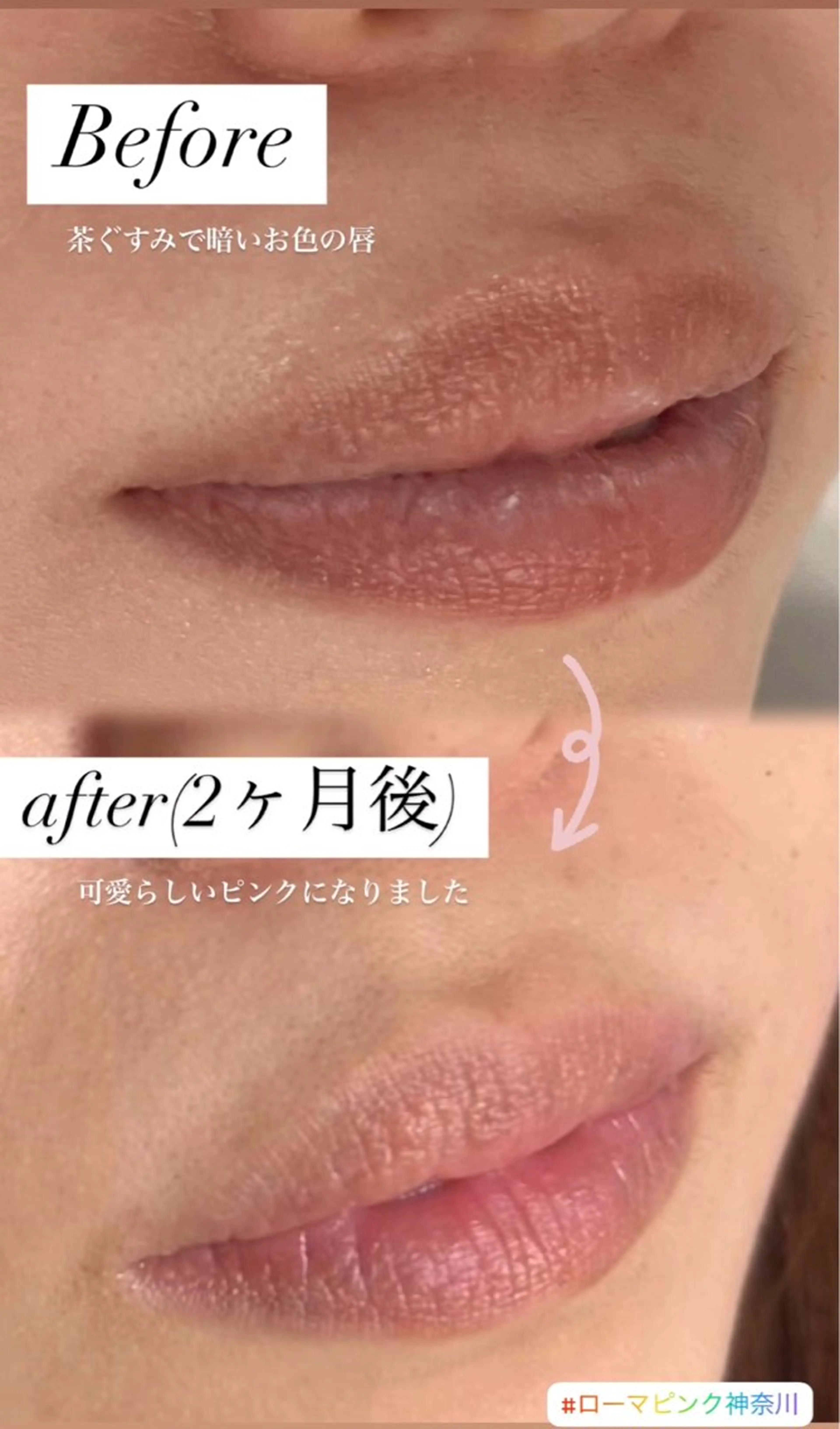 その他 【ローマピンク施術】 Kaoのその他イメージ