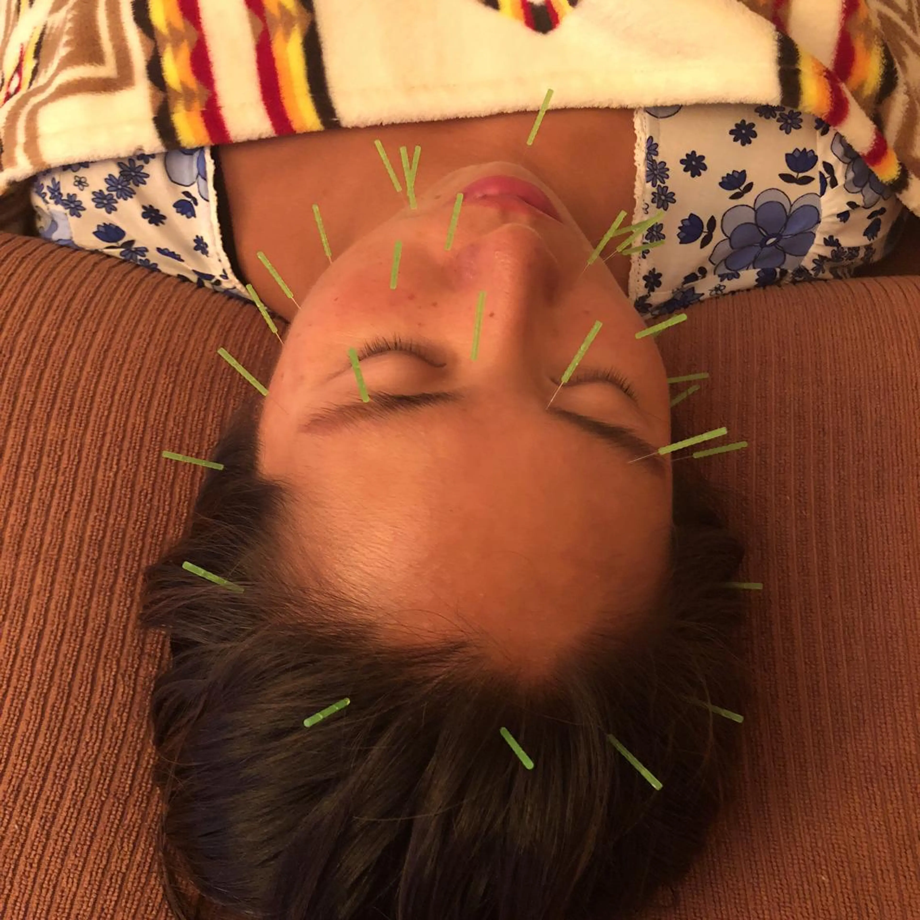 美容鍼レギュラーコース（お顔のみ）の写真