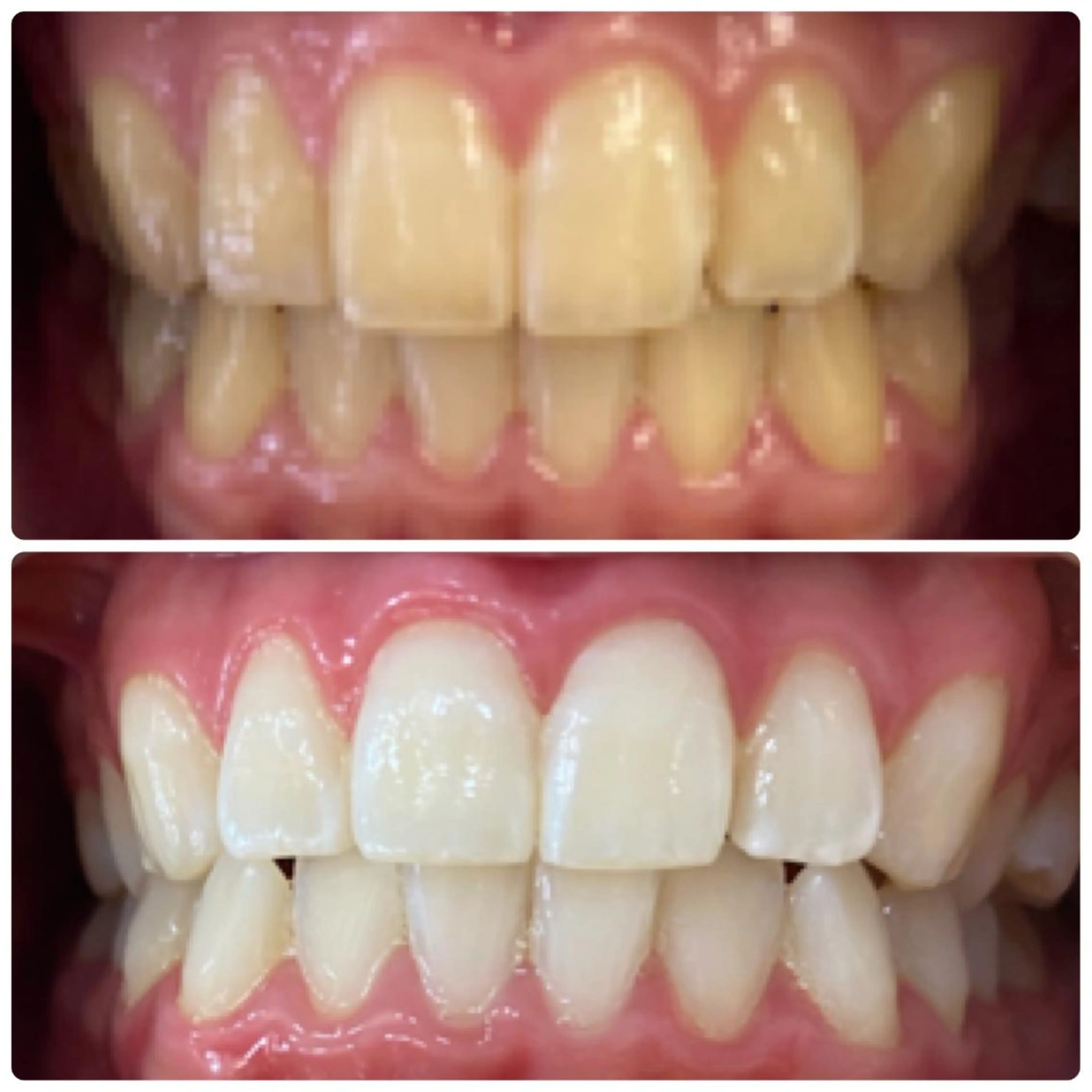 【1日3名限定】1day完結プラン🦷30分×2照射 1日で限界まで白く!の写真