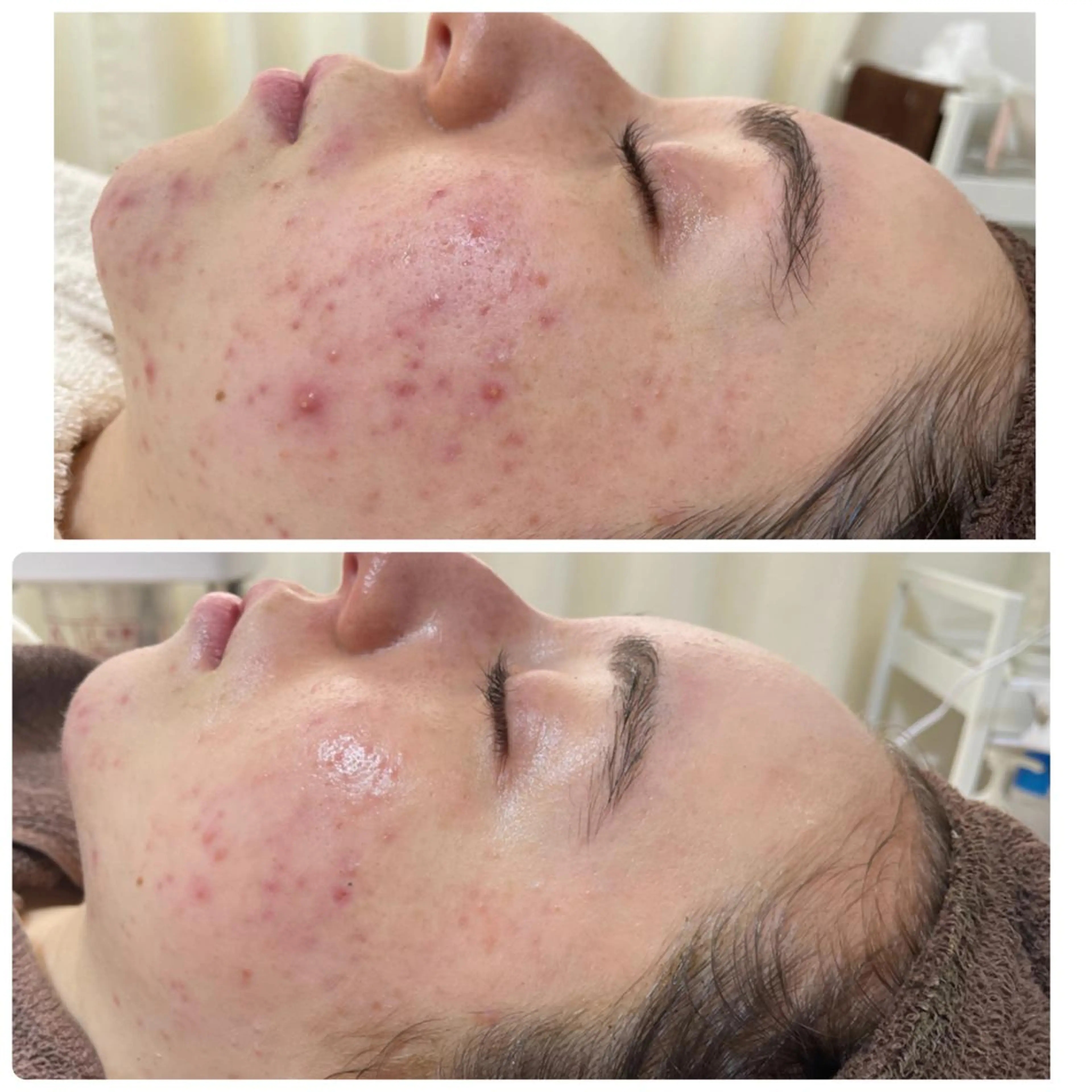 マツエク・マツパ アイブロウ エステ ニキビ・毛穴改善 🌿ハーブピーリングのエステ・リラクイメージ