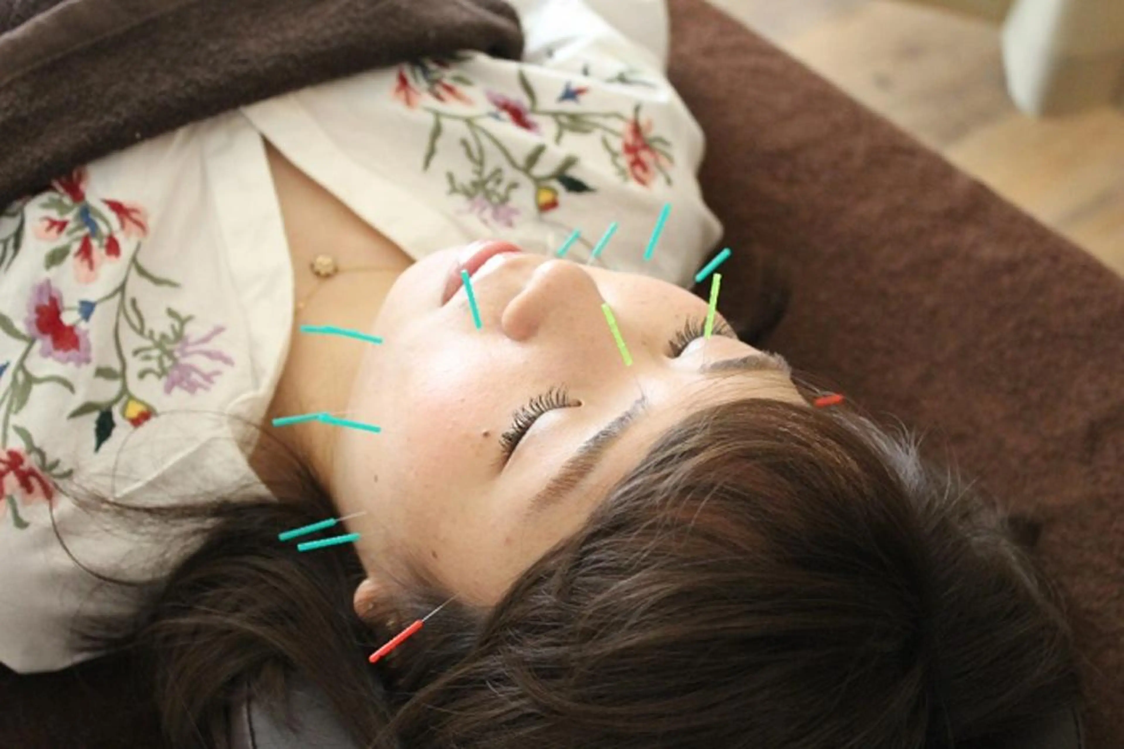 むくみスッキリ小顔に 【美容はり】の写真