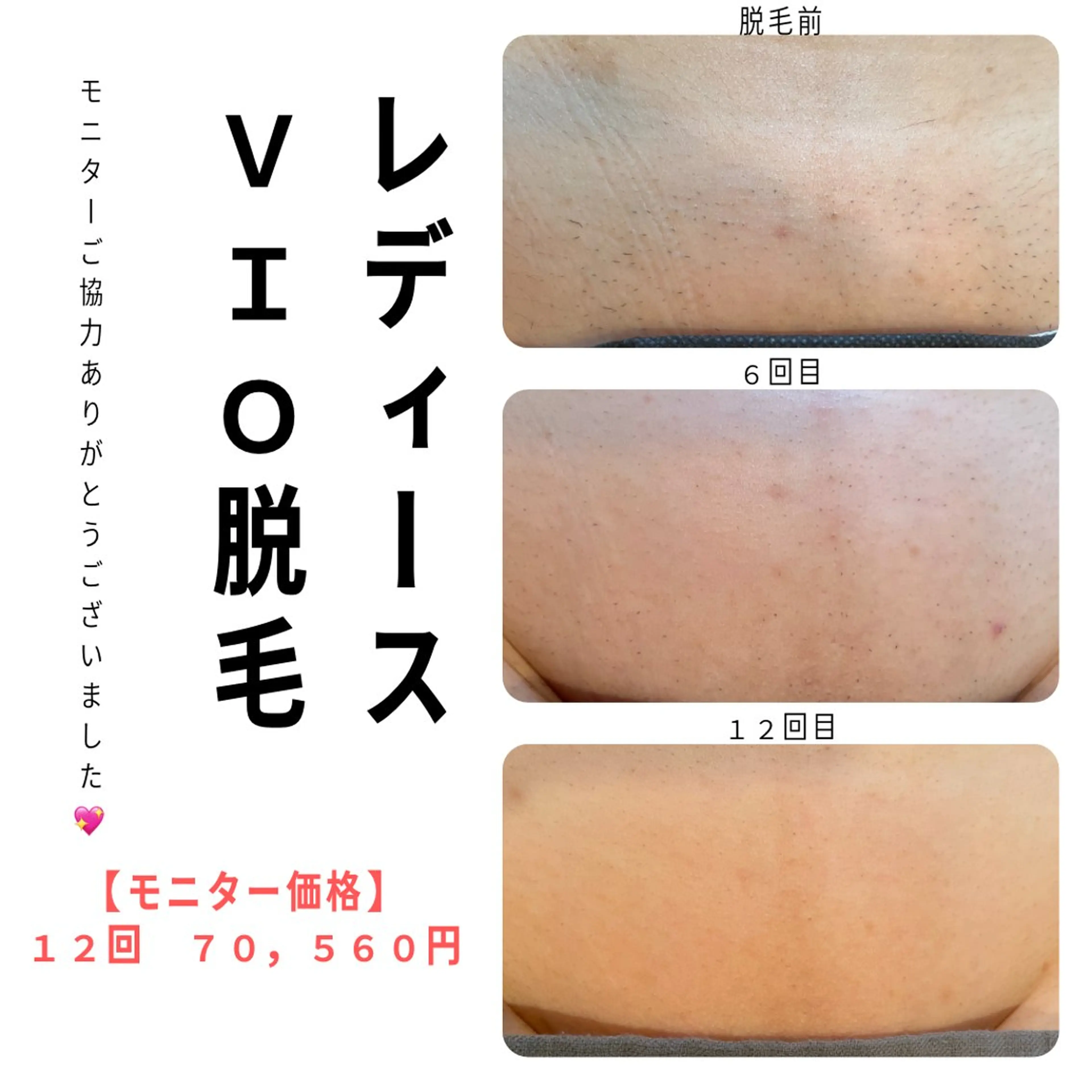 脱毛 private脱毛 salon HALEのエステ・リラクイメージ