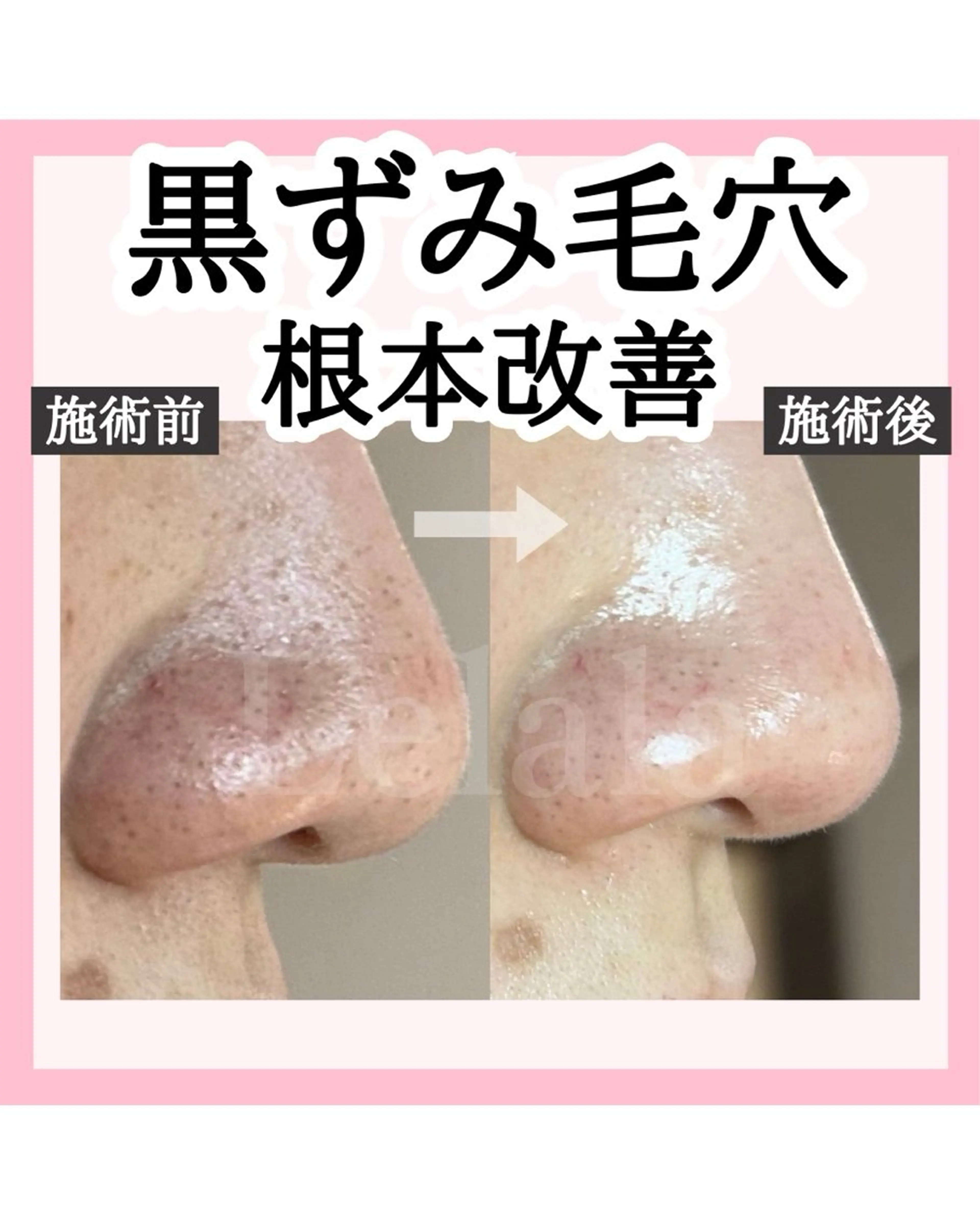 毛穴汚れをごっそり大掃除！黒ずみ一掃！つるんと毛穴レス肌への写真