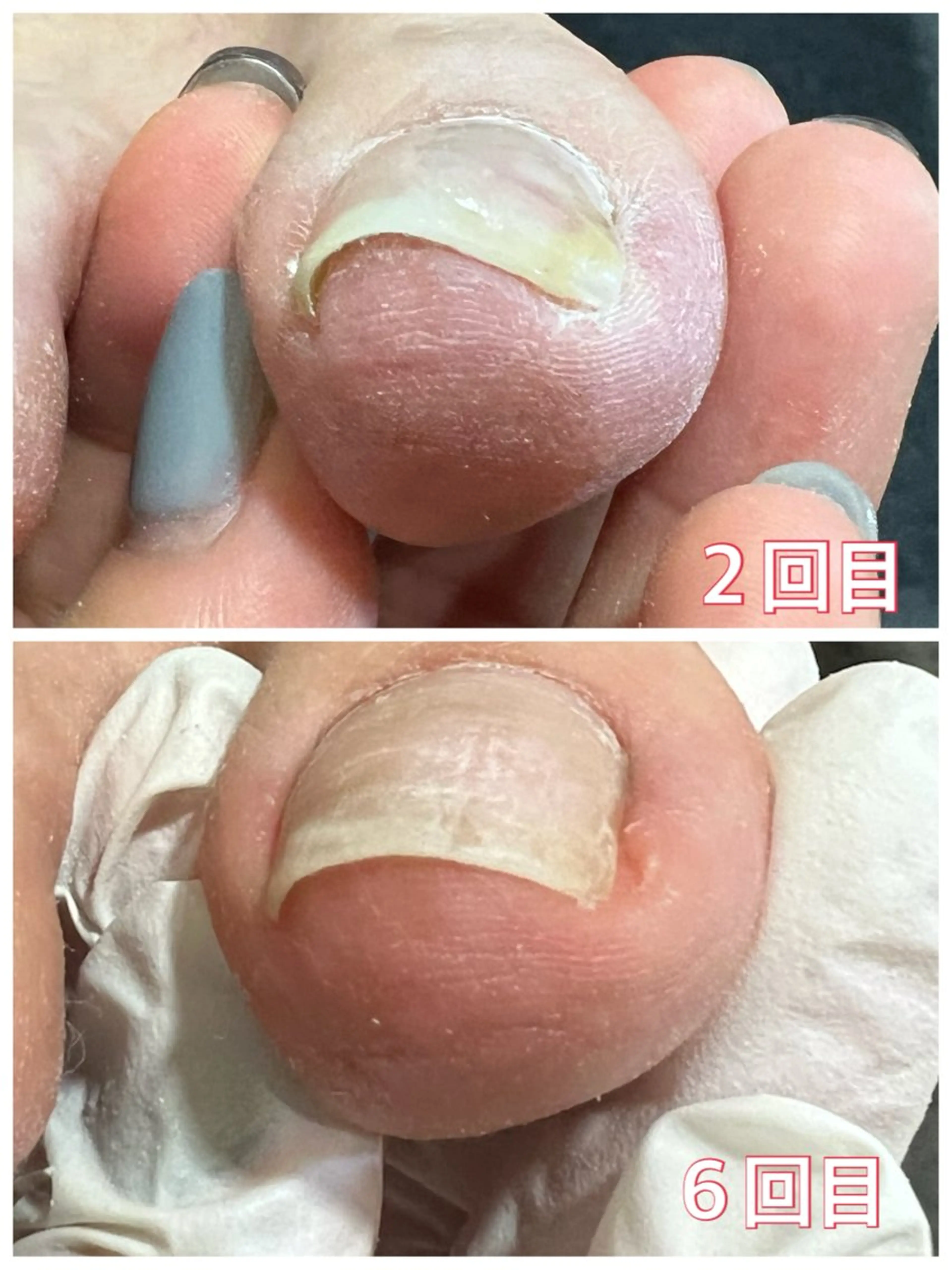 ネイル フットネイル 巻き爪補正店 堺東店のネイルデザイン