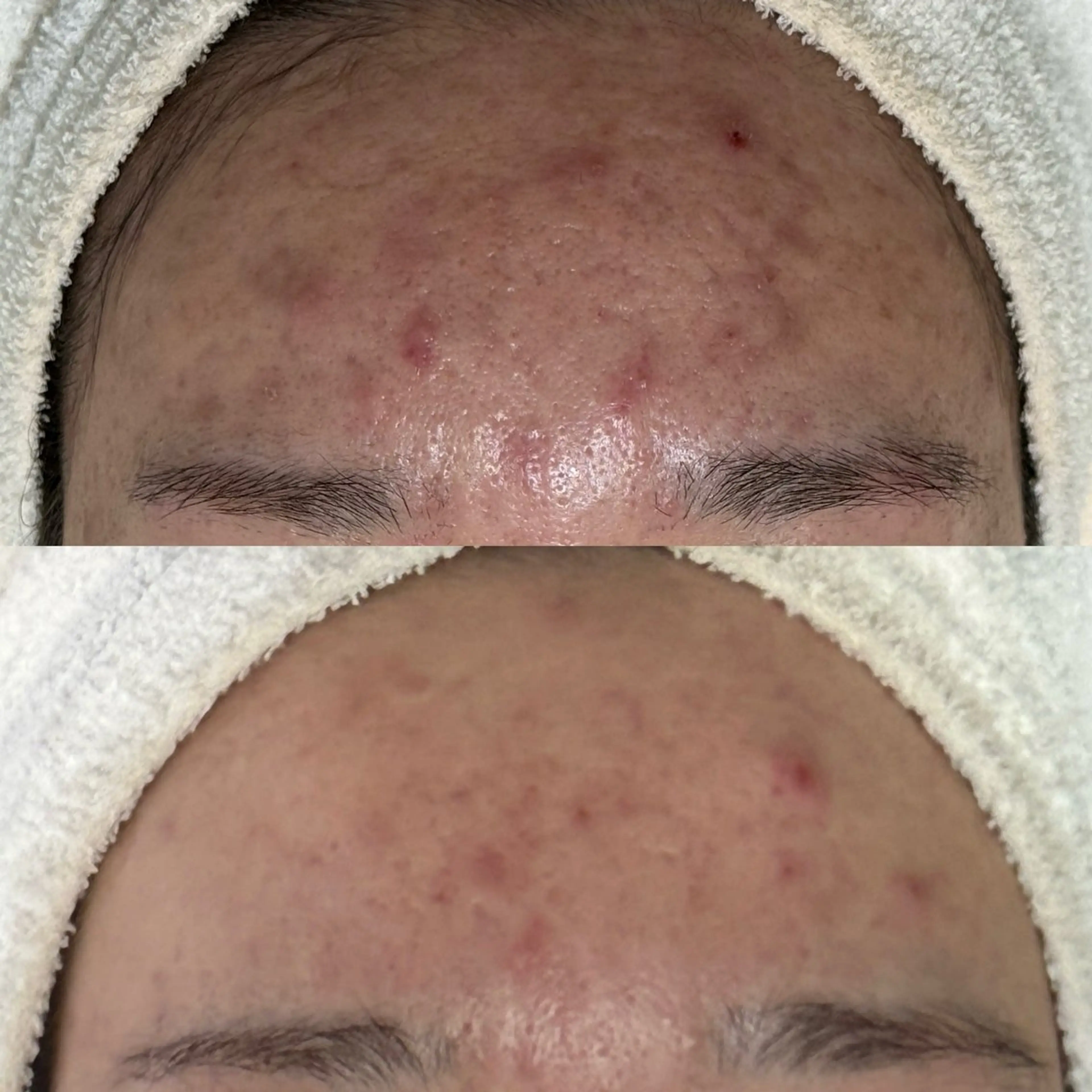 ニキビ・毛穴・ フェイシャル専門店のエステ・リラクイメージ