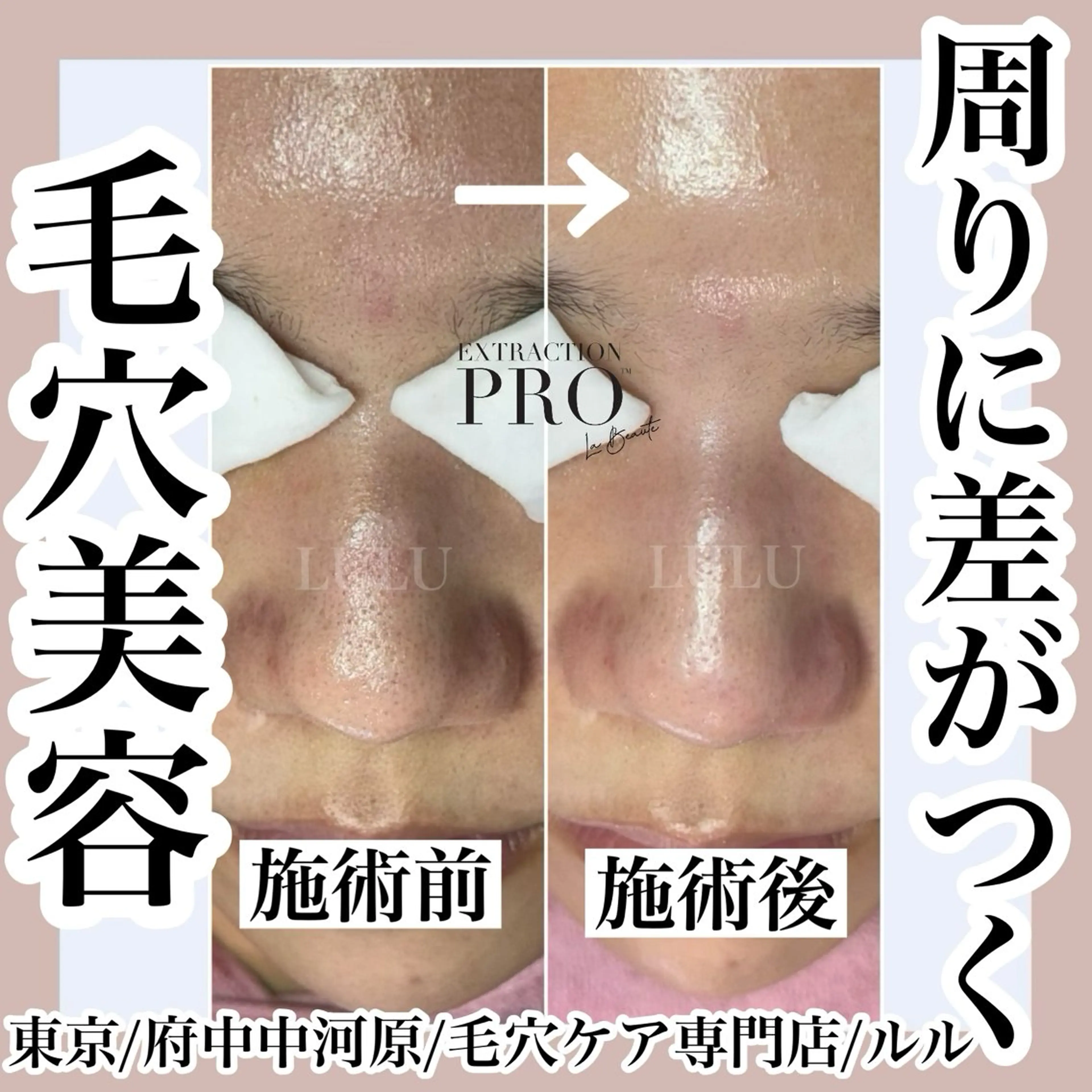 SNSで大人気‼️始めた人から綺麗に‼️毛穴美人コース、ラボーテ式毛穴エクストラクションプロの写真