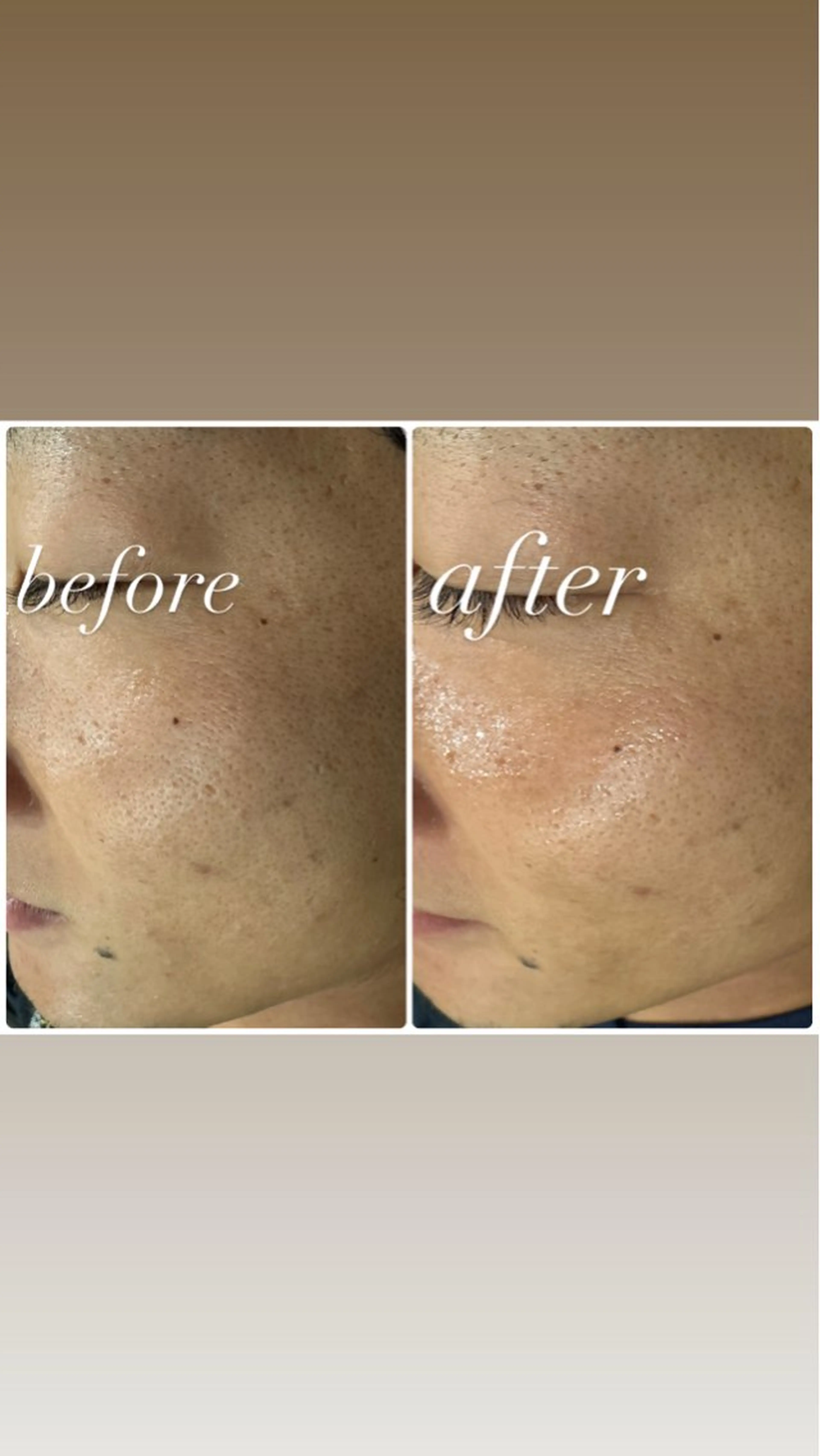 TikTokで話題【ララピール& 選べる!顔脱毛or毛穴洗浄】¥11,000の写真