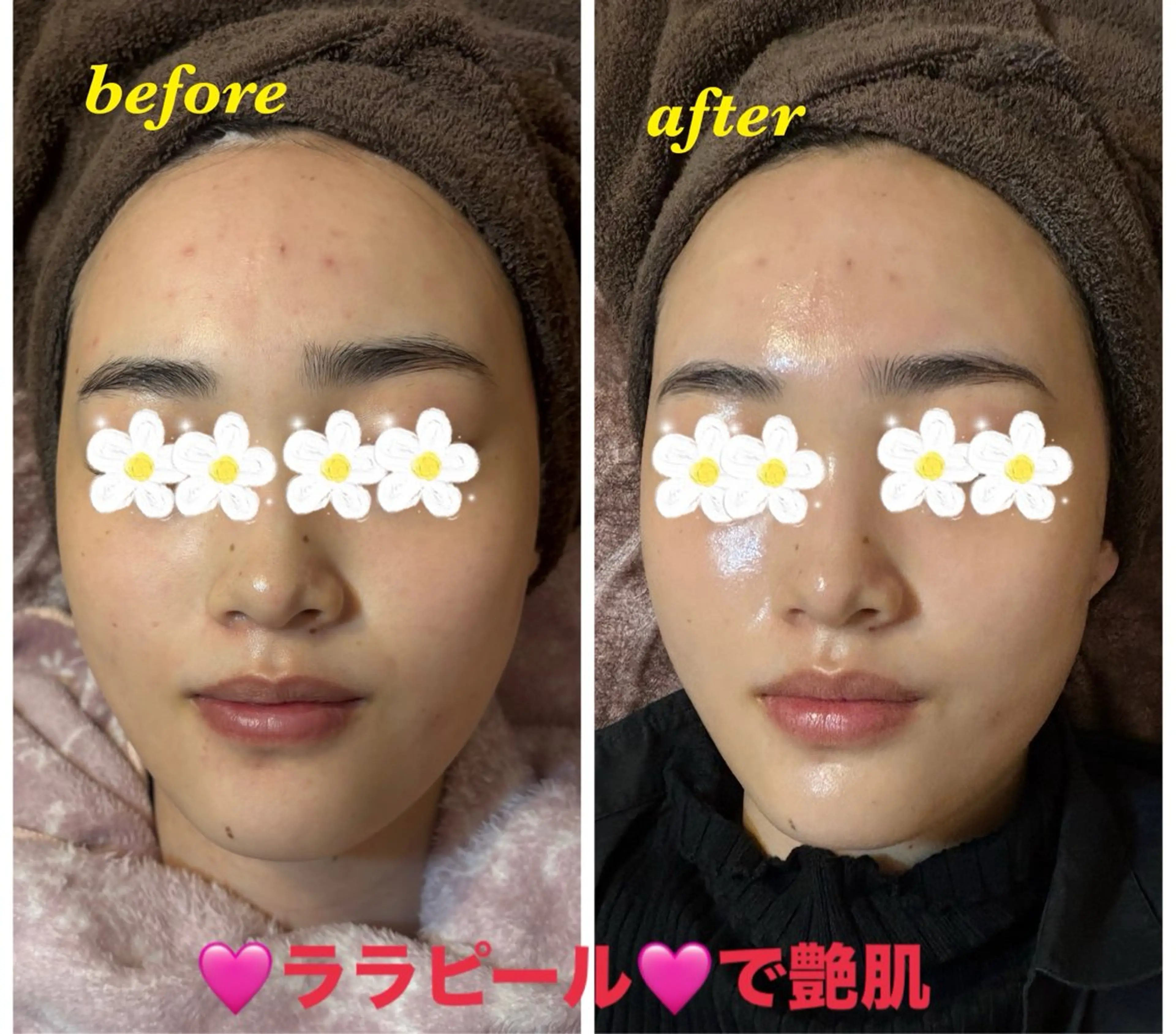 エステ ハーブピーリング専門 毛穴洗浄❤️眉waxのエステ・リラクイメージ