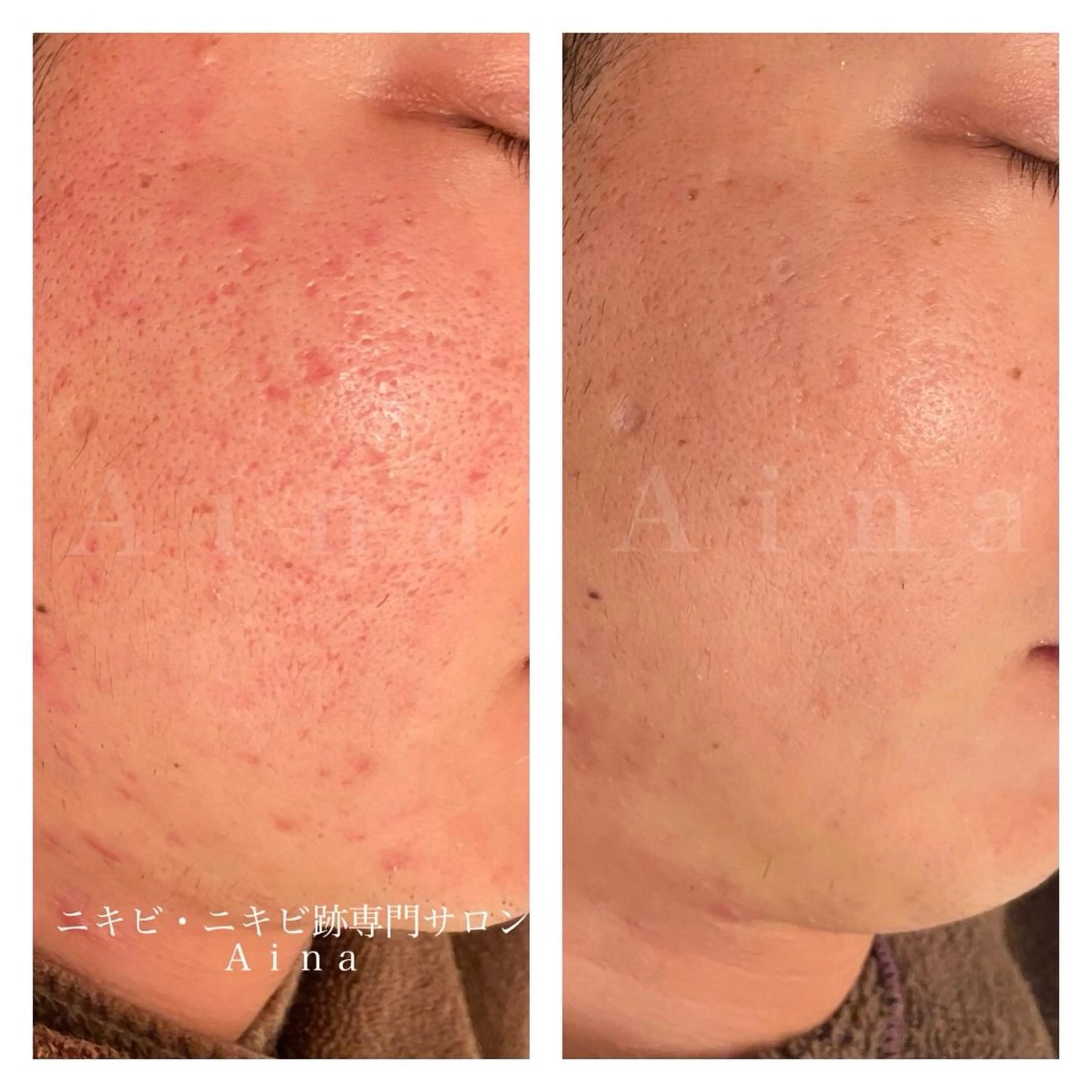 エステ リラク ニキビ跡専門サロン Ａｉｎａのエステ・リラクイメージ